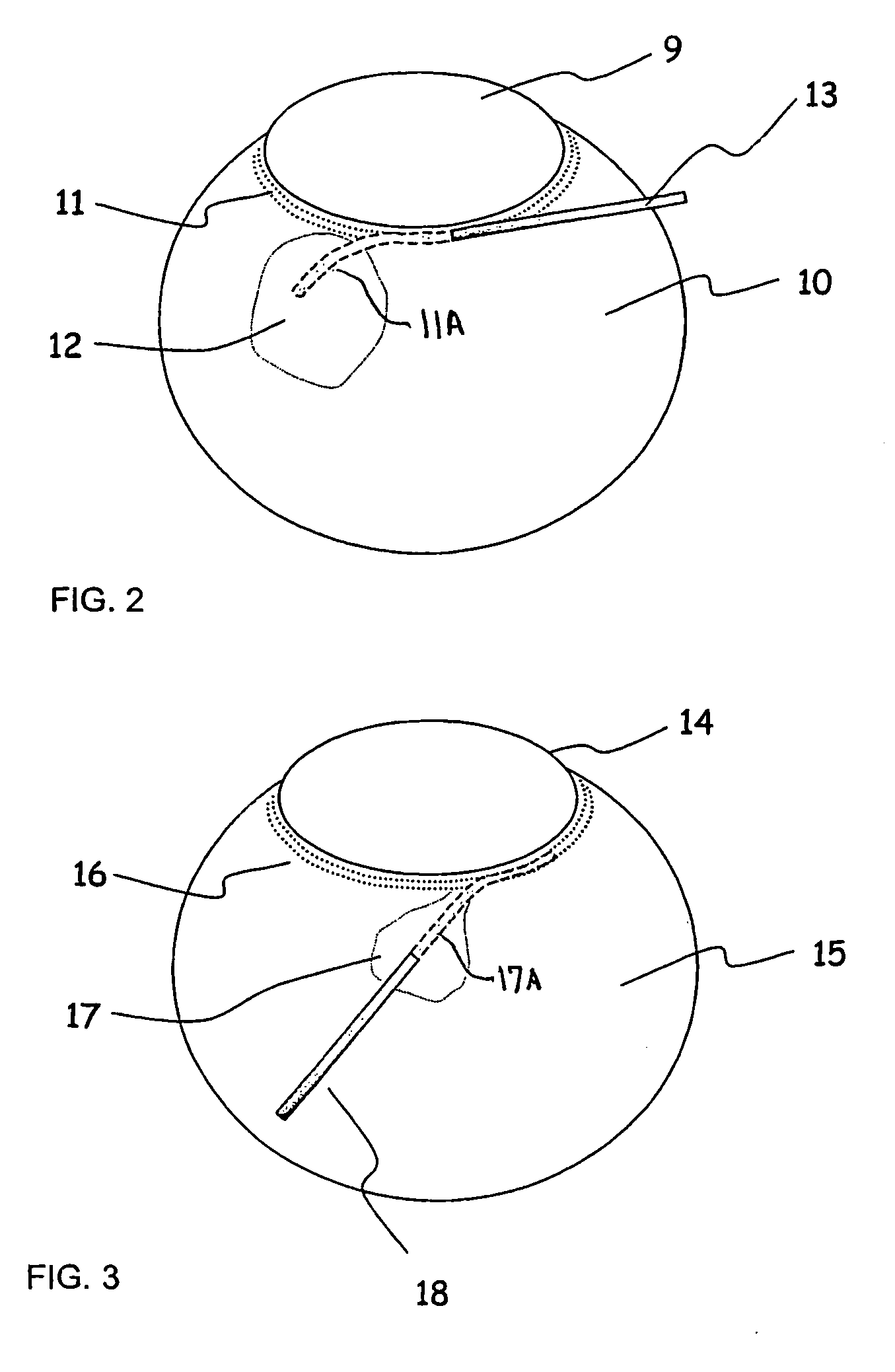 Apparatus And Method For Surgical Enhancement Of Aqueous Humor Drainage