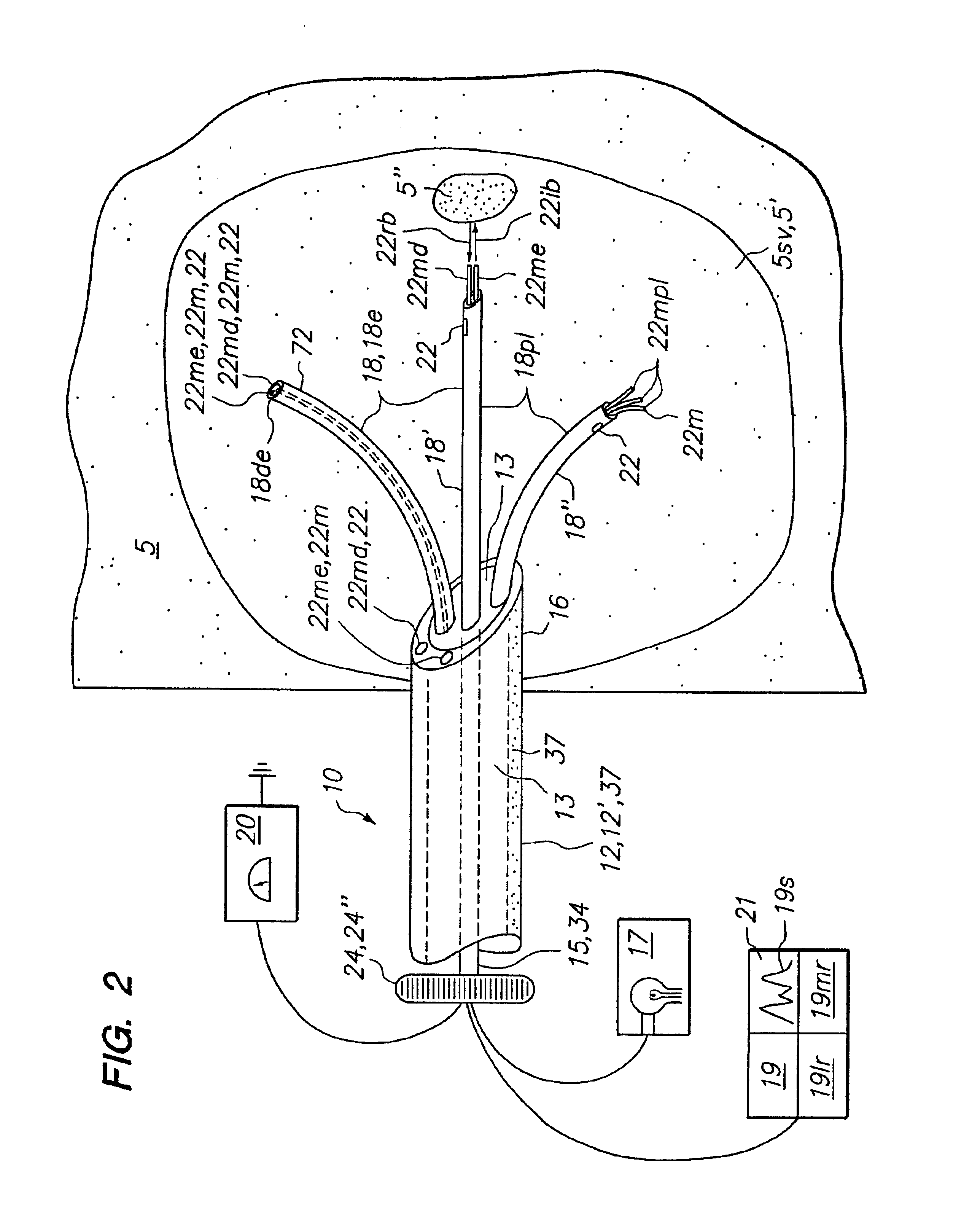 Tissue biopsy and treatment apparatus and method