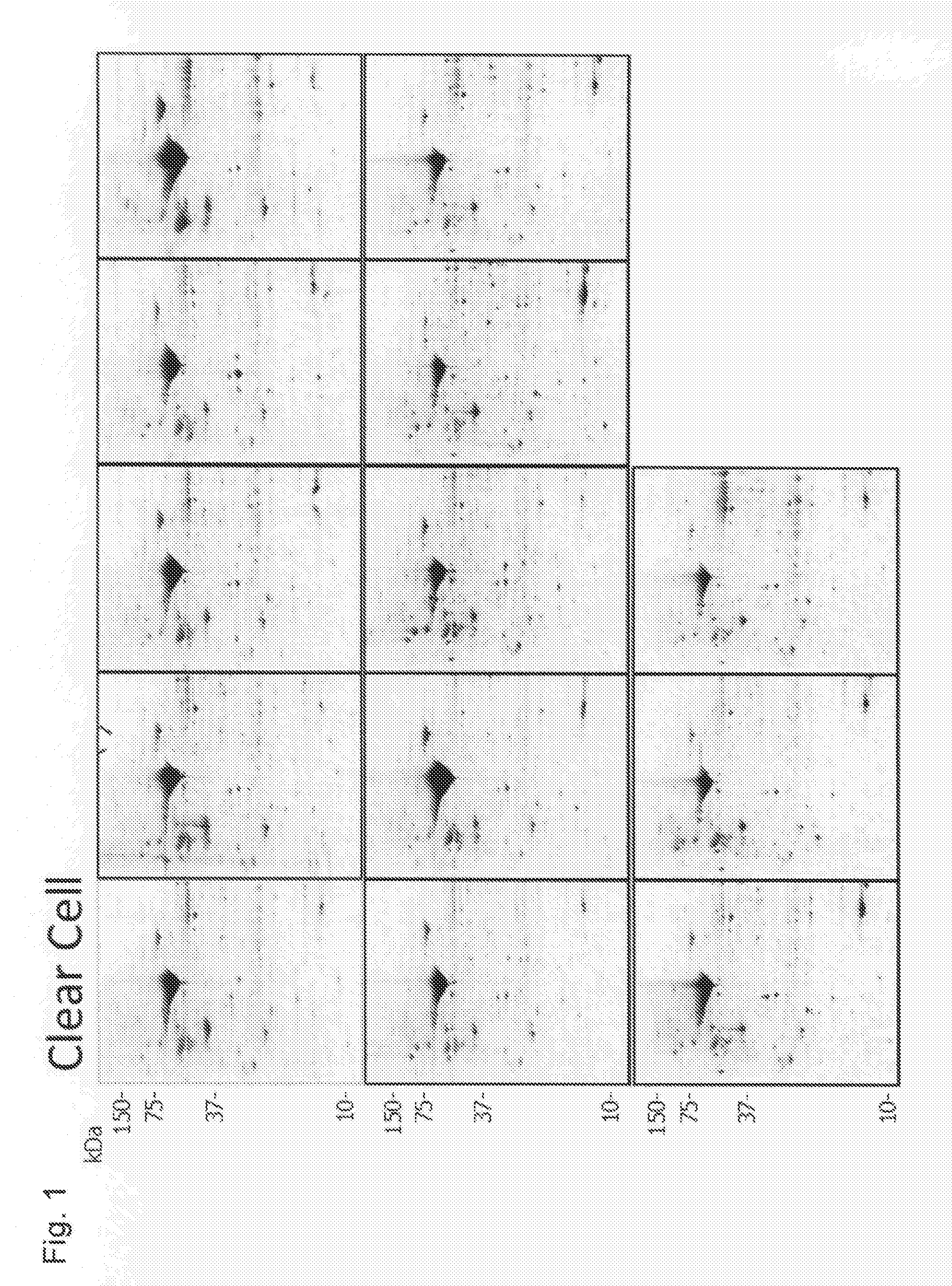 Marker for identification of tissue type of epithelial ovarian cancer, and method for determination of the occurrence of epithelial ovarian cancer based on tissue type by using the marker