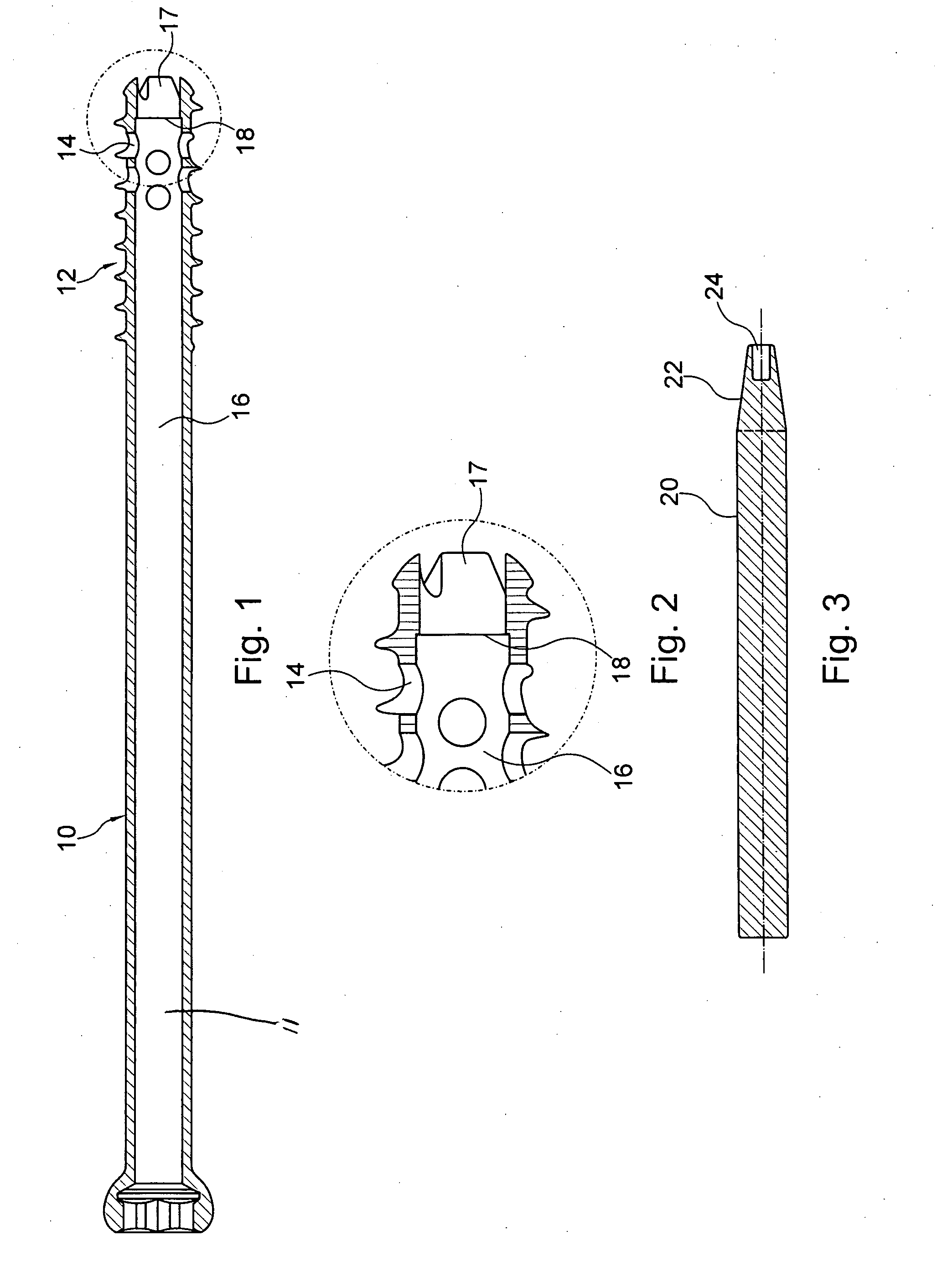 Device for fixation of bone fractures