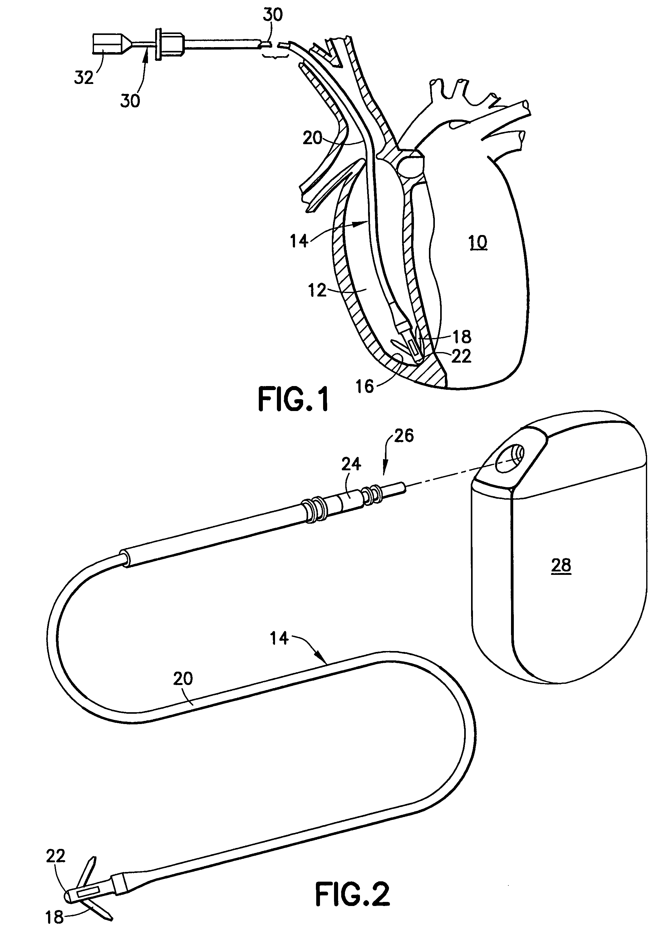 Construction of a medical electrical lead