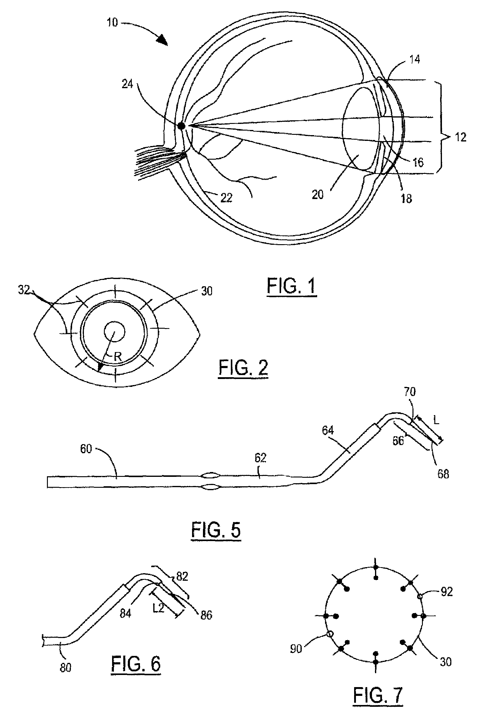 Method and system for conductive keratoplasty