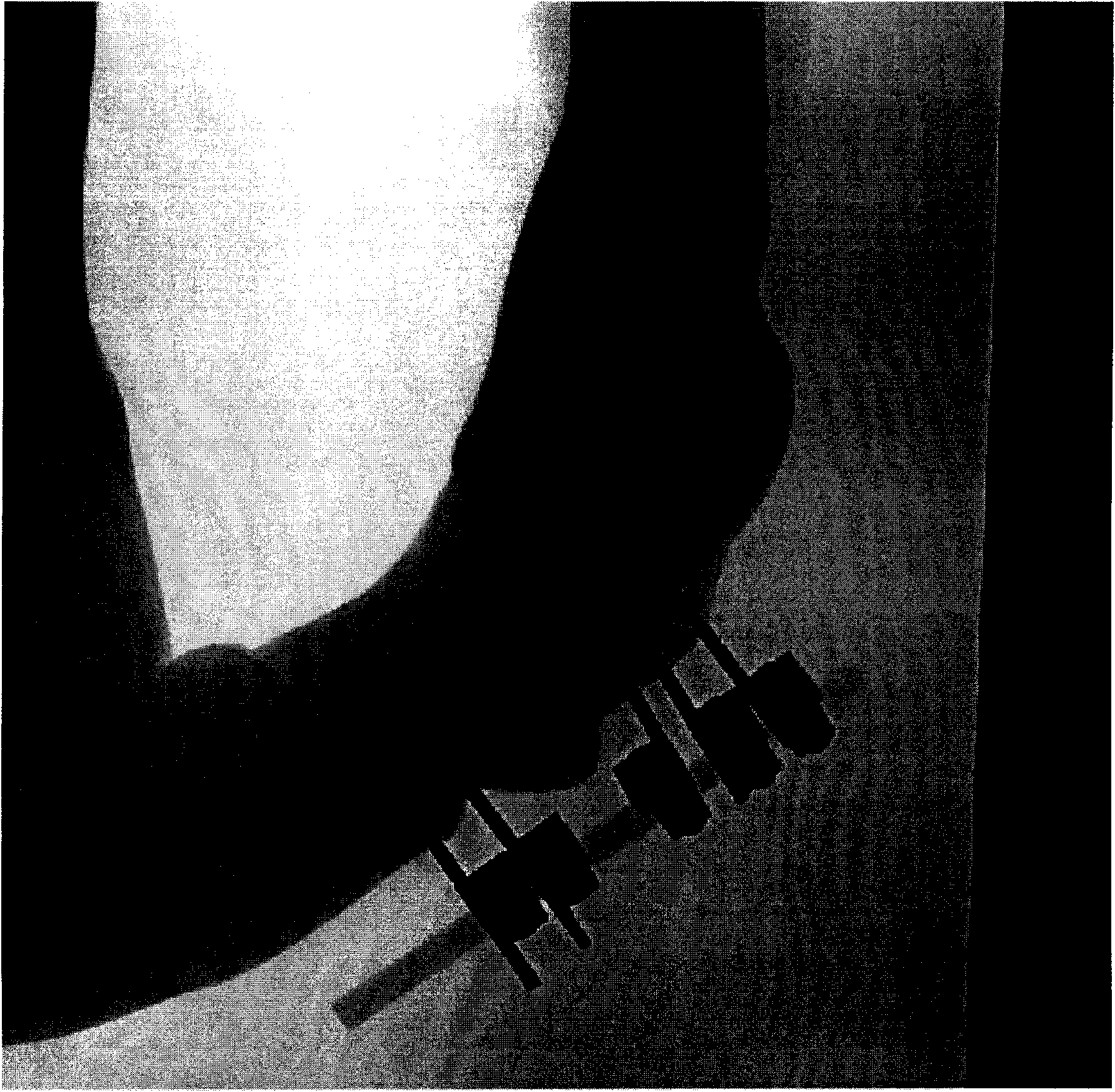 Method and device for extracting metallic foreign body from X-ray image