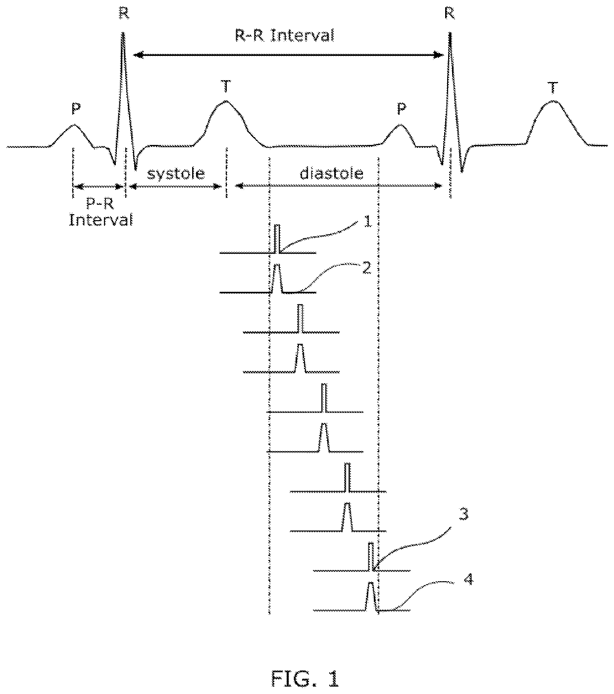 System and Method of Image Improvement for Multiple Pulsed X-ray Source-in-Motion Tomosynthesis Apparatus Using Electrocardiogram Synchronization