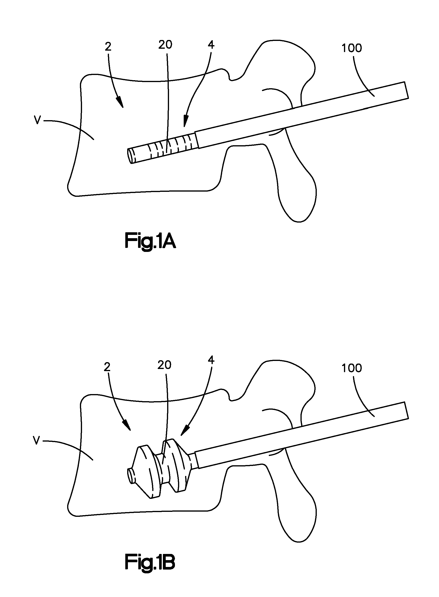 Porous containment device and associated method for stabilization of vertebral compression fractures