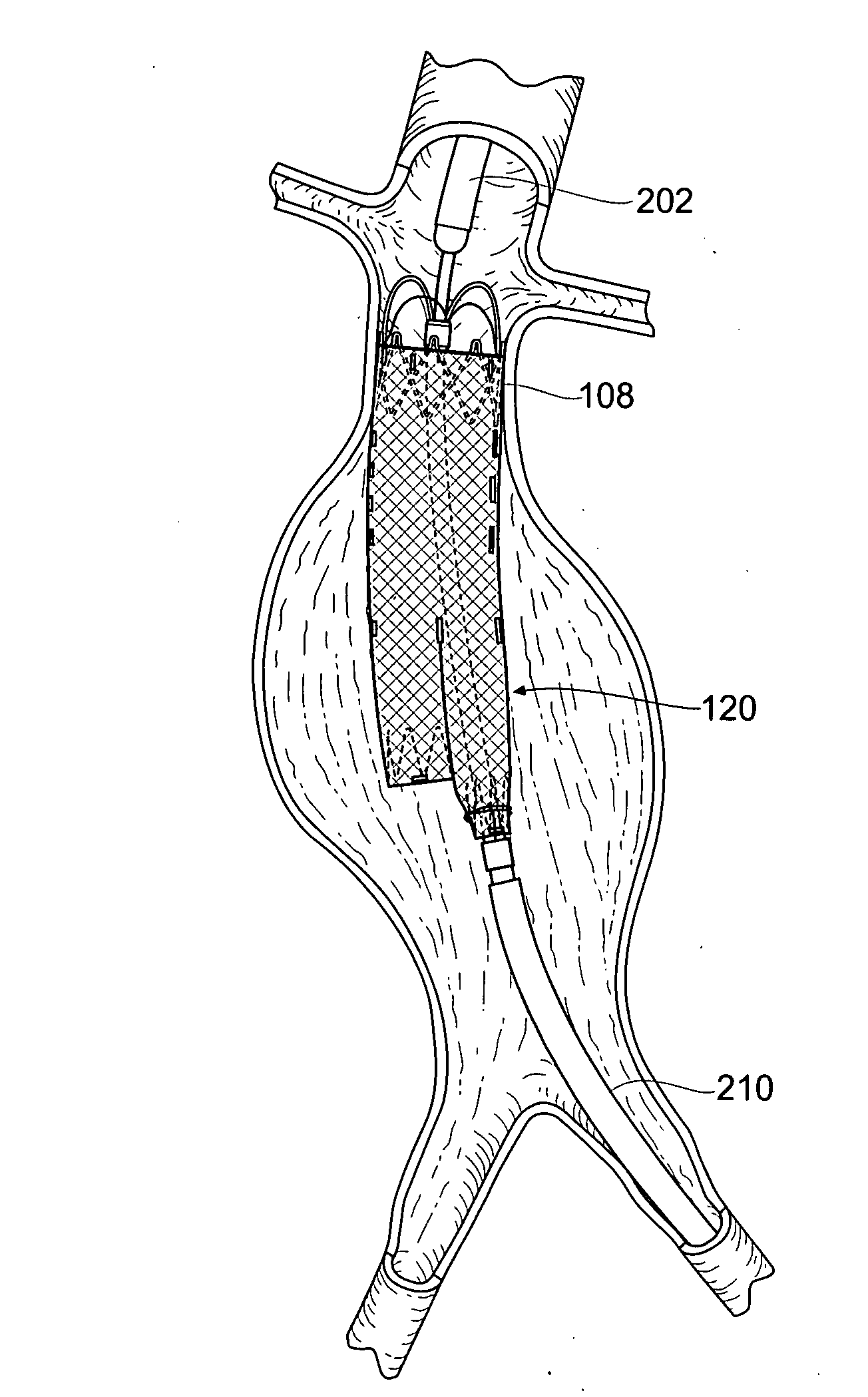 Devices, systems, and methods for prosthesis delivery and implantation