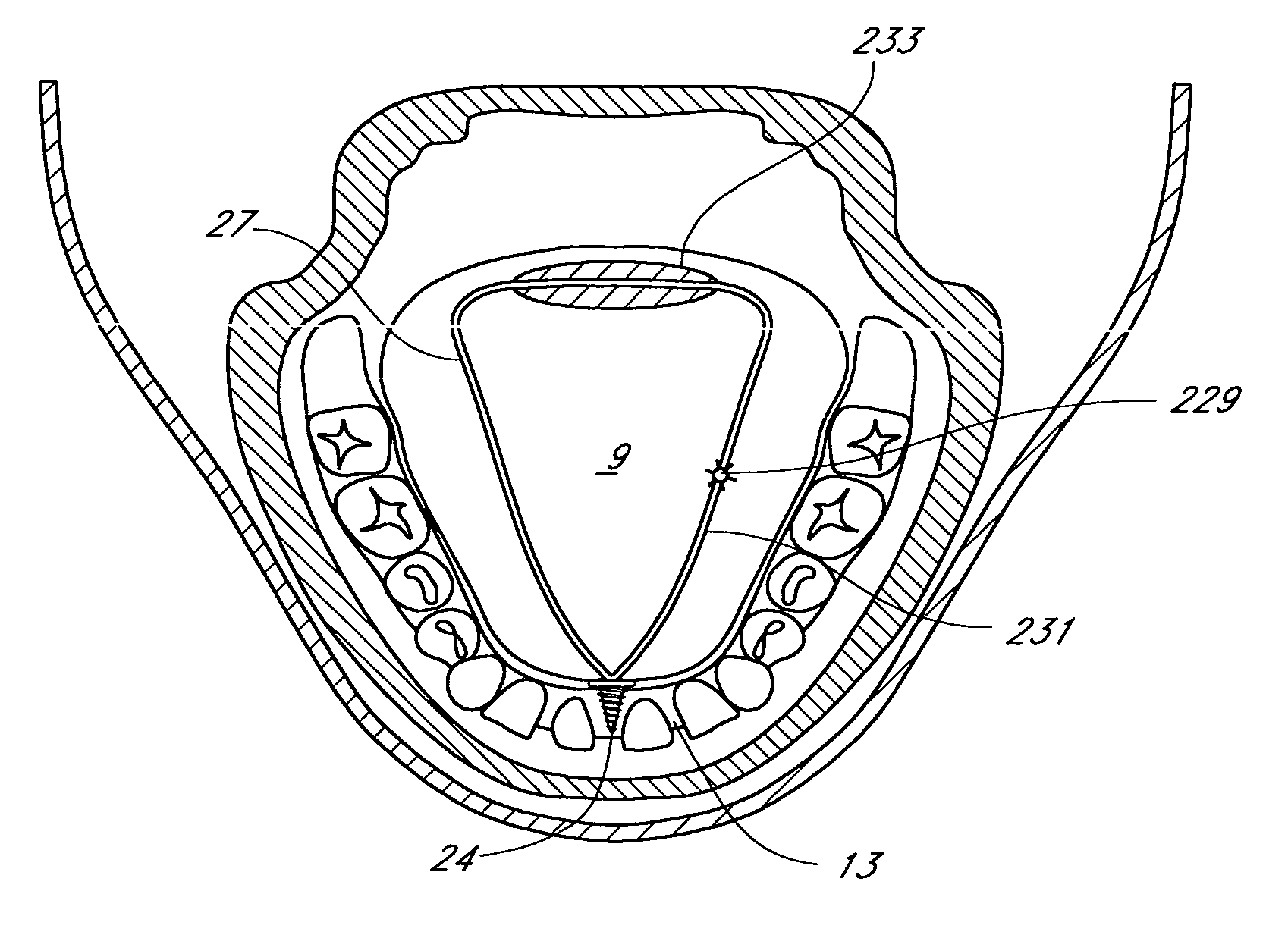 Tissue anchoring system for percutaneous glossoplasty