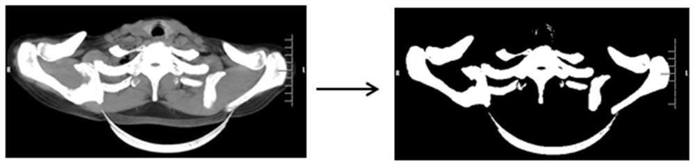 Acromioclavicular joint CT image processing method