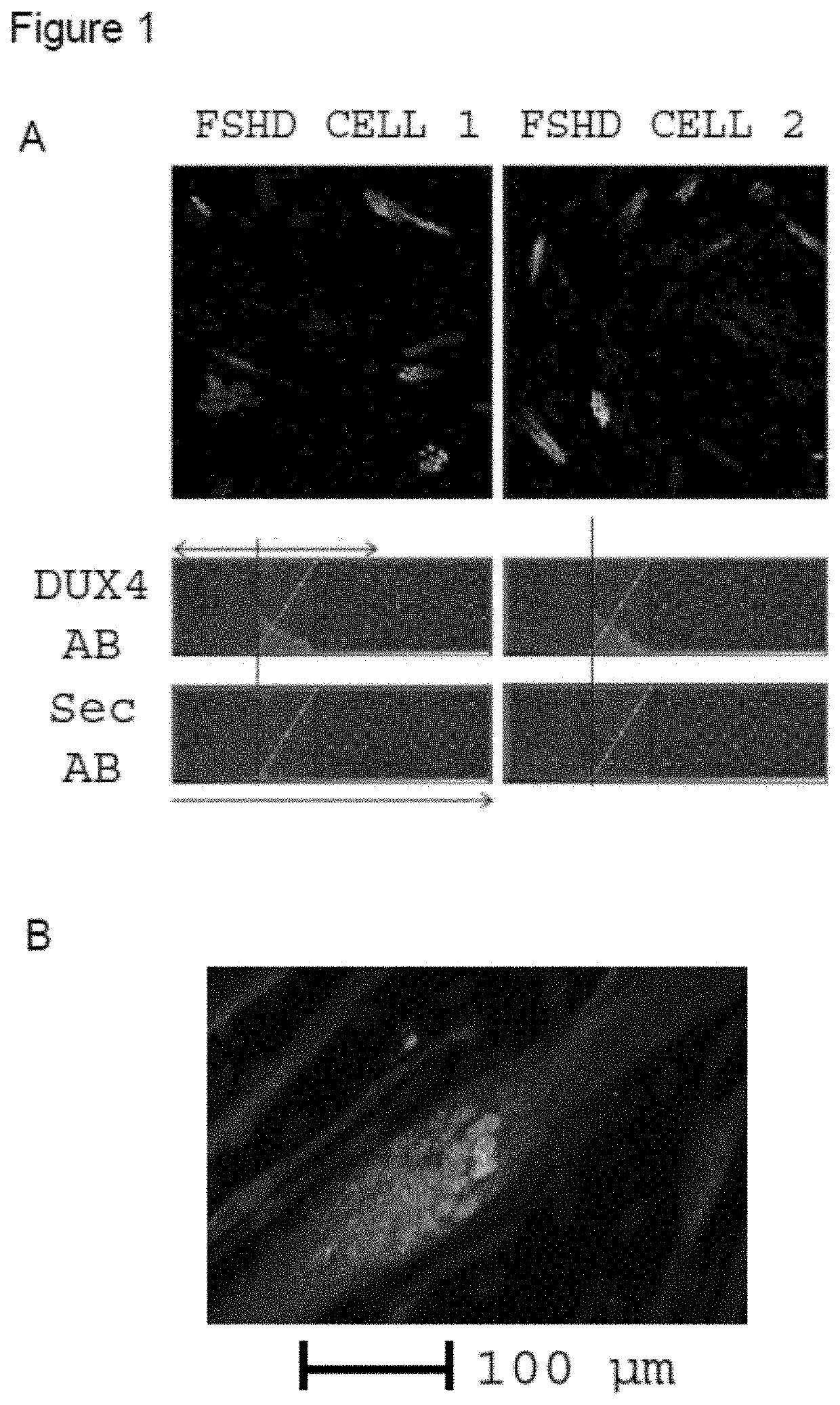 Casein kinase 1 inhibitors for use in the treatment of diseases related to dux4 expression such as muscular dystrophy and cancer