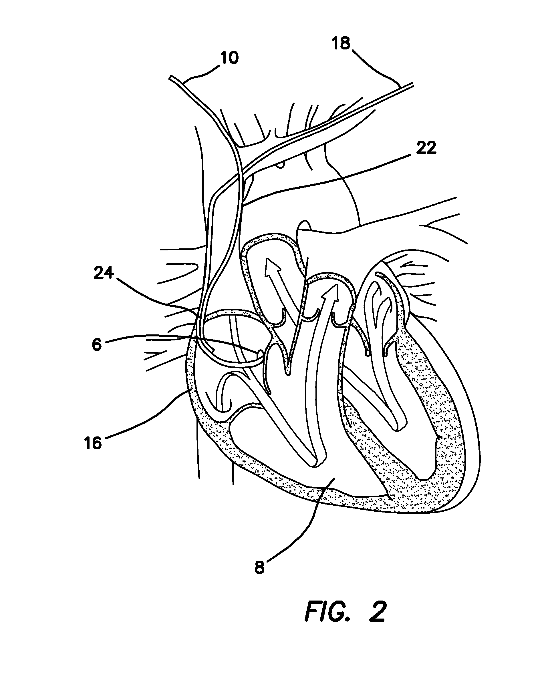 Method and Apparatus for a Right-Sided Short Sheath