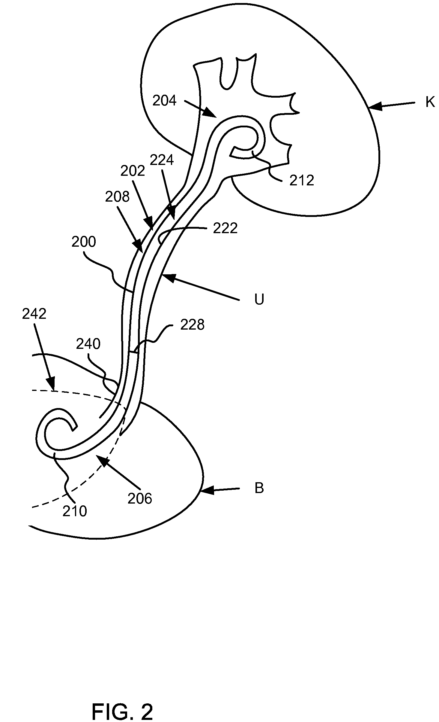 Stent with soluble bladder retention member