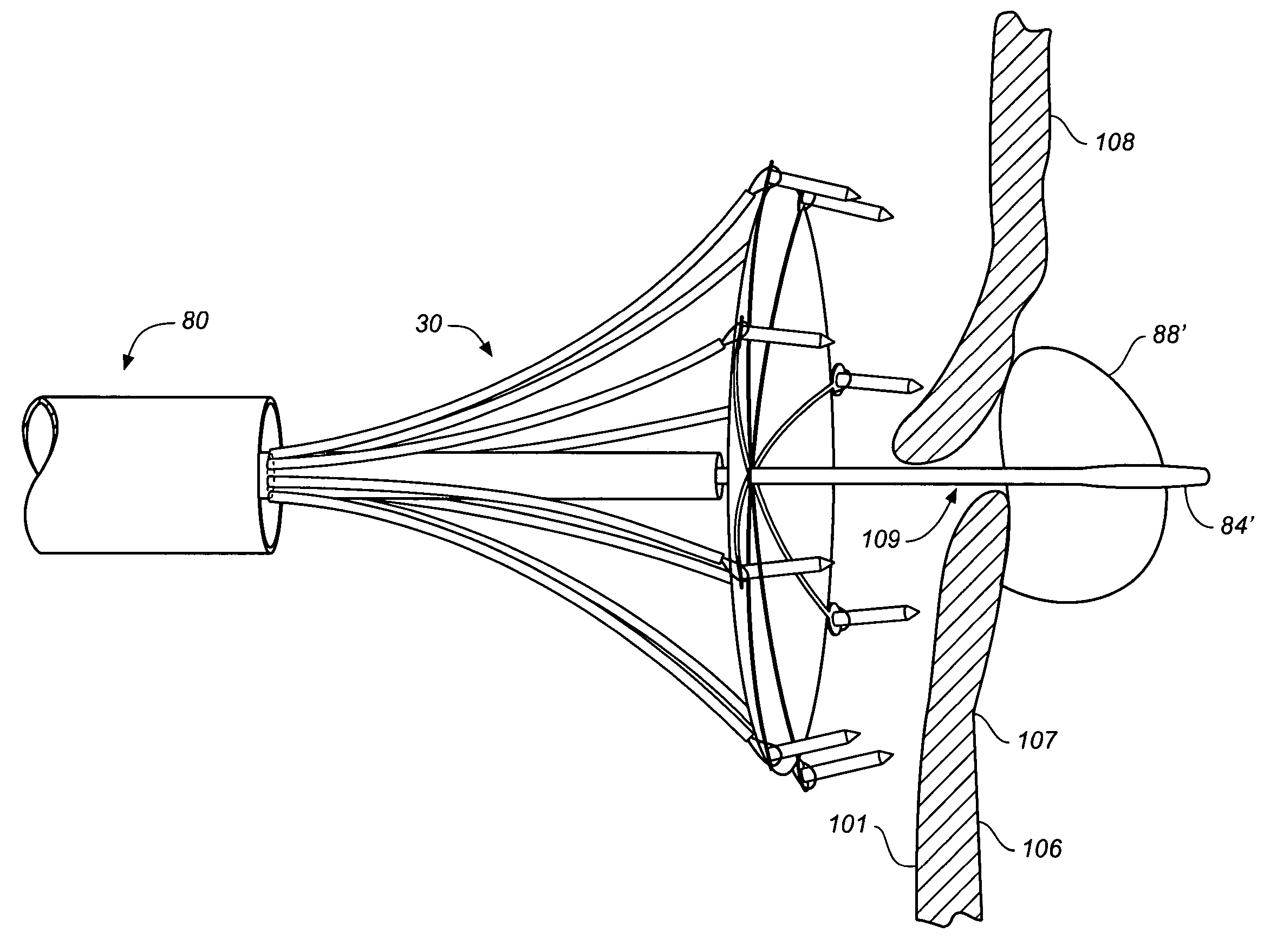Cardiovascular defect patch device and method