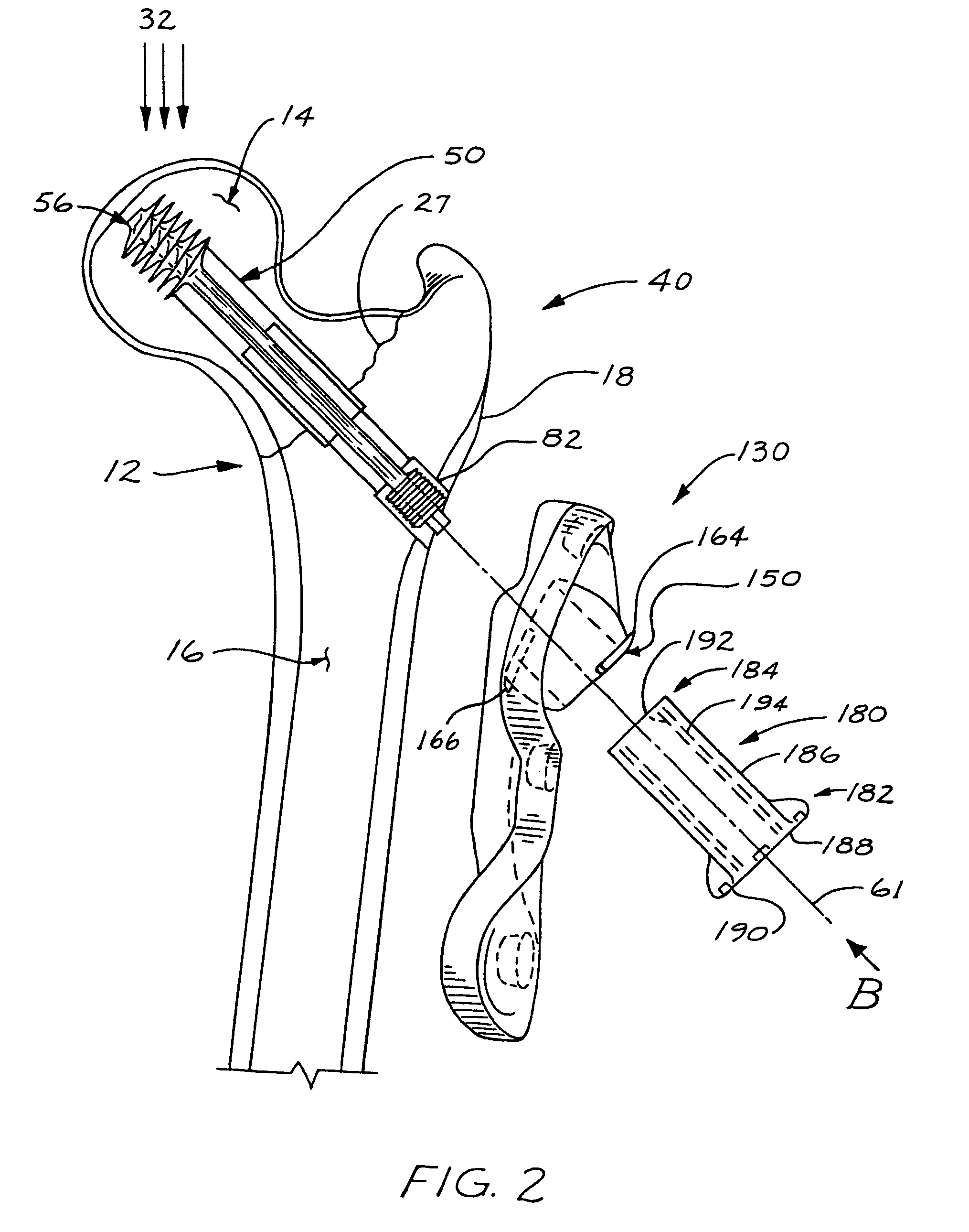 Compression bone screw device