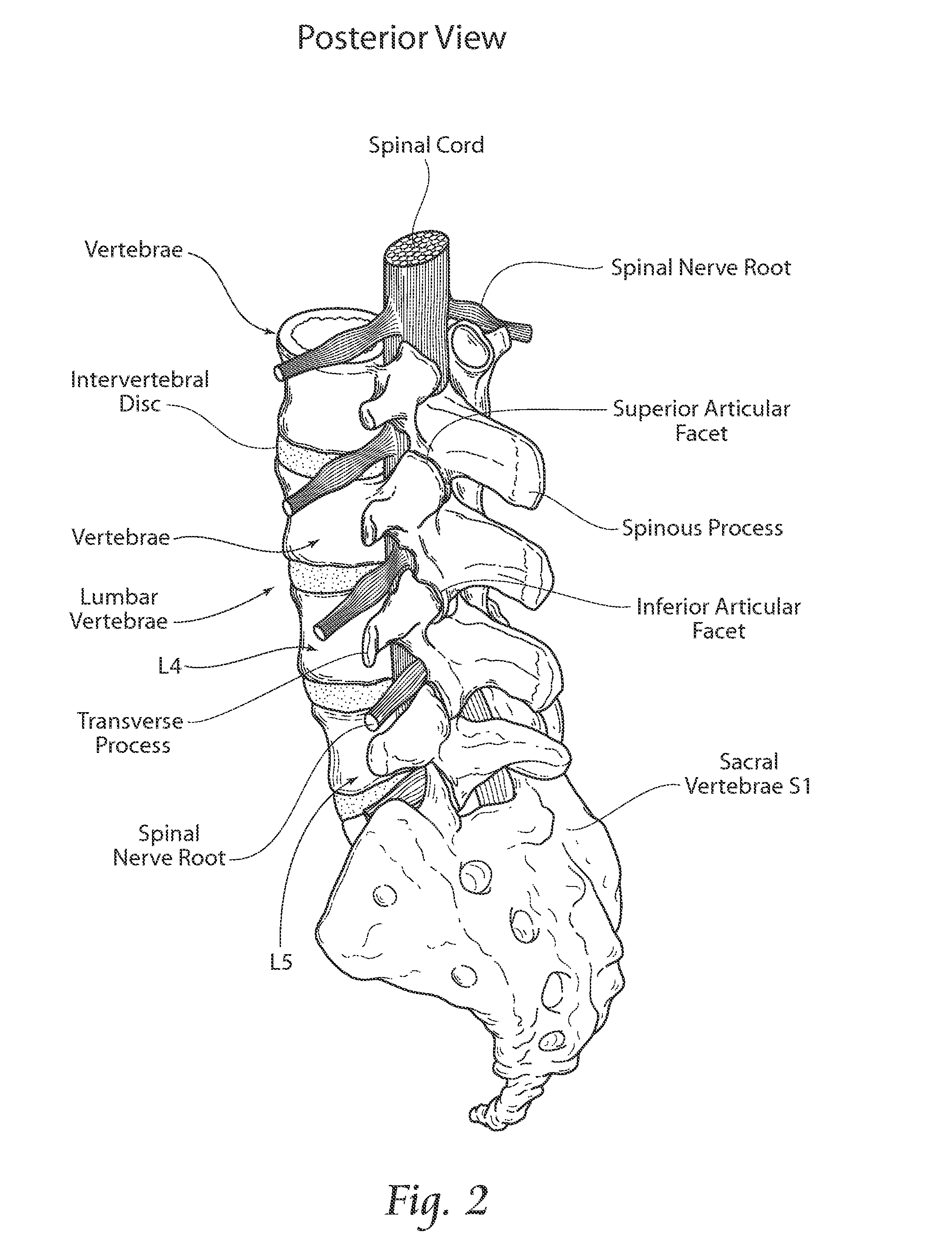 Apparatus, systems, and methods for achieving anterior lumbar interbody fusion