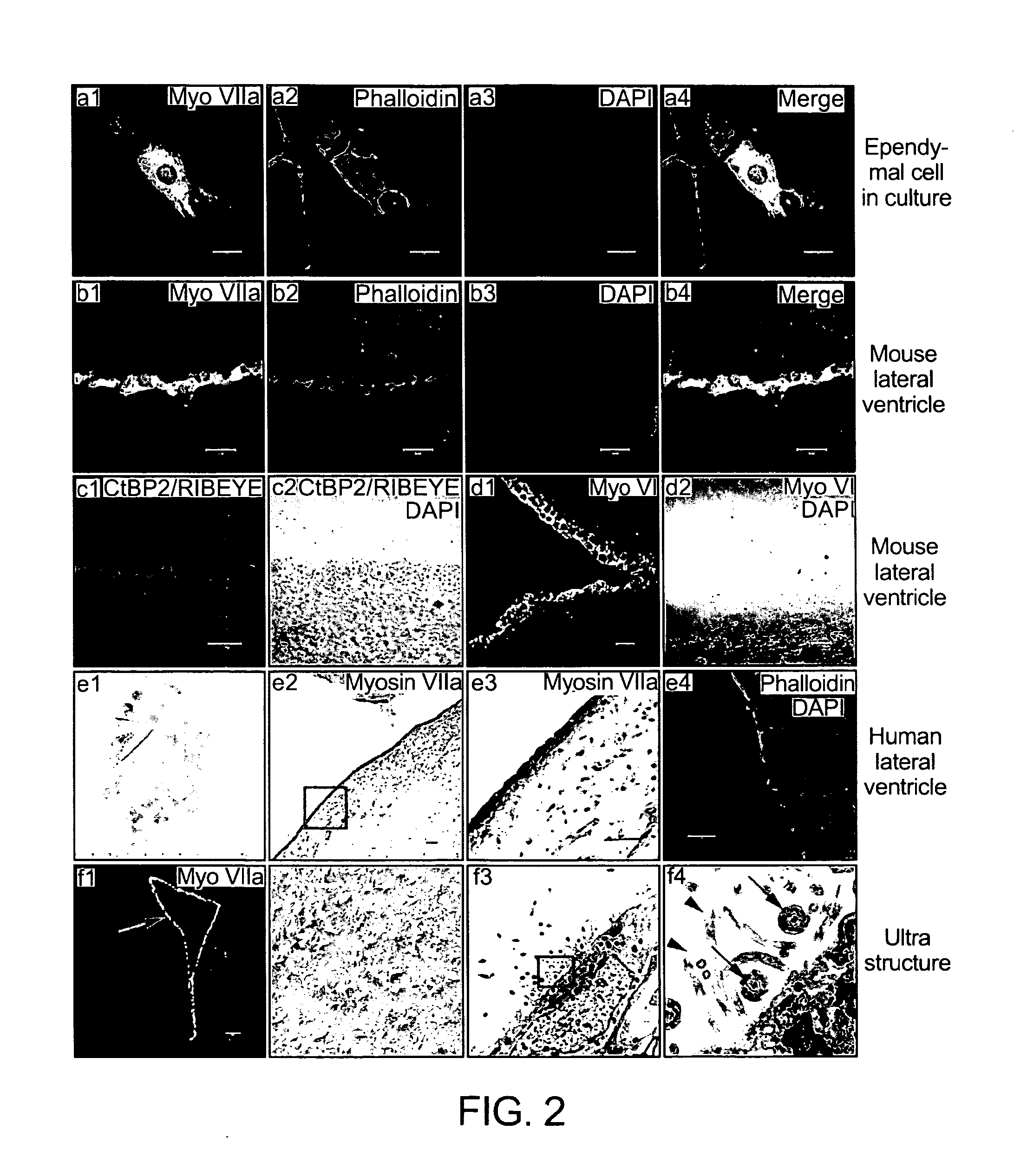 Lateral ventricle cell compositions and use for treating neural degenerative diseases