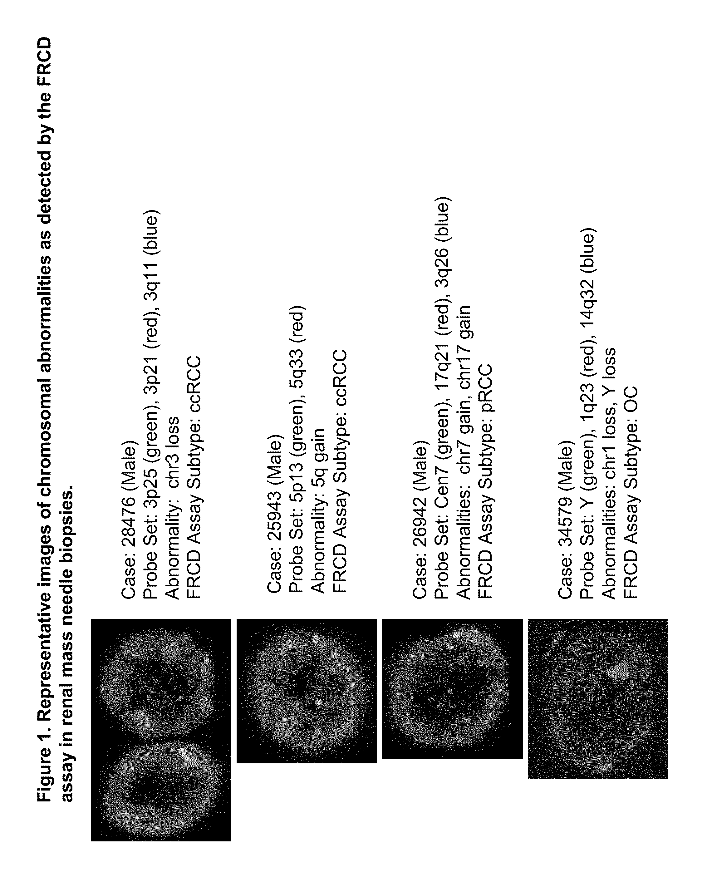 Panel for the detection and differentiation of renal cortical neoplasms