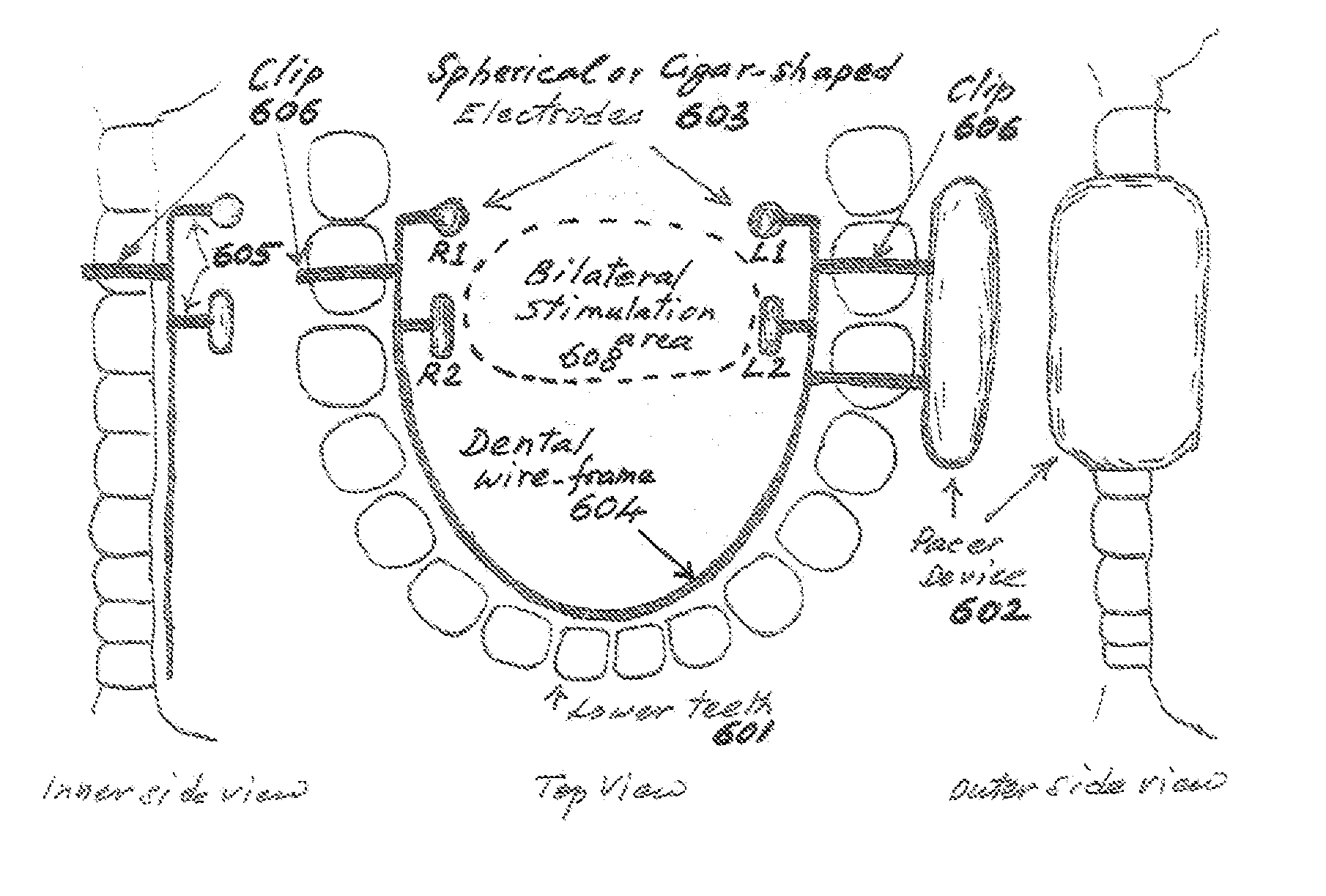 Non-invasive intraoral electrical stimulator system and method for treatment of obstructive sleep apnea (OSA)