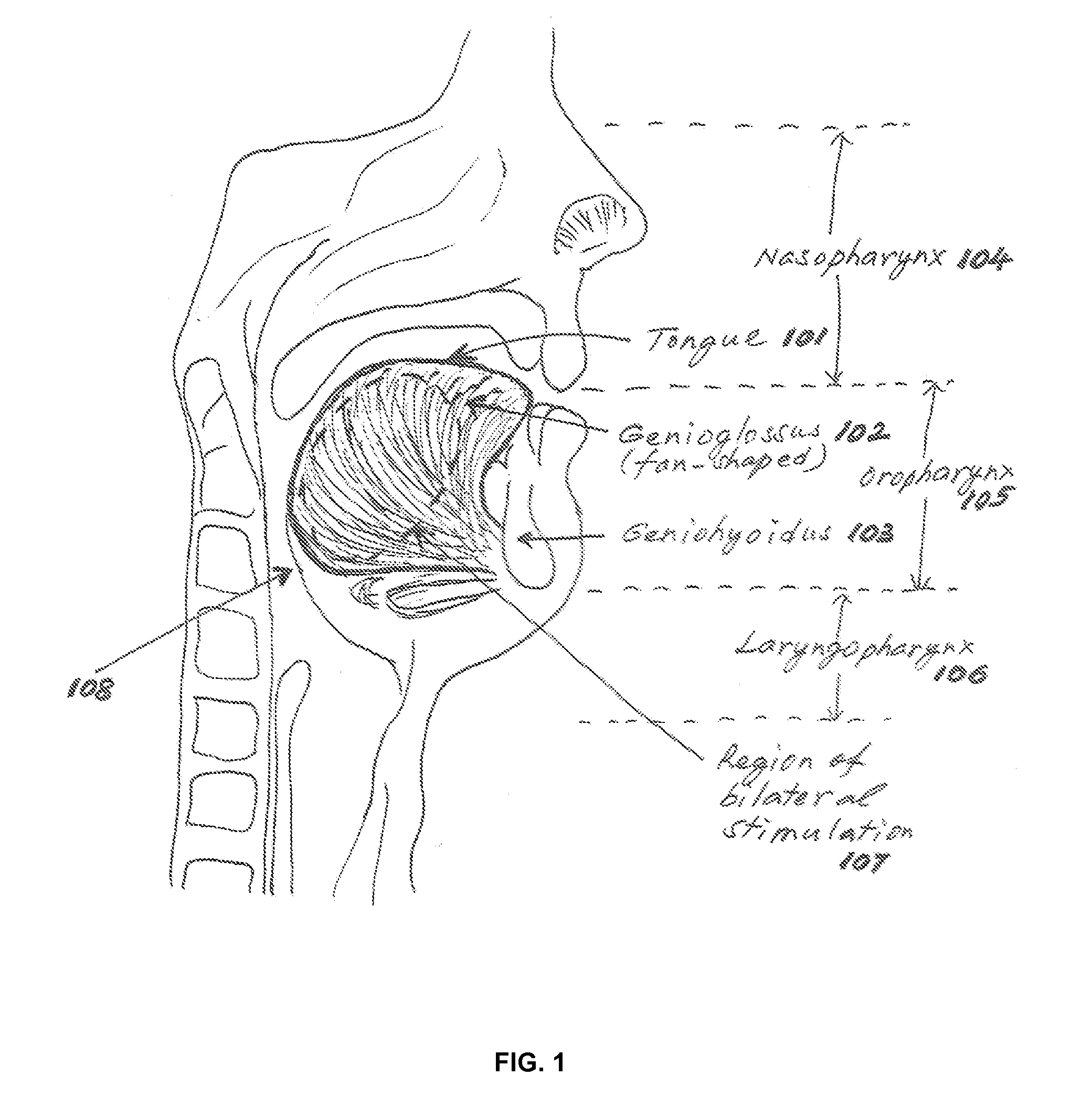 Non-invasive intraoral electrical stimulator system and method for treatment of obstructive sleep apnea (OSA)