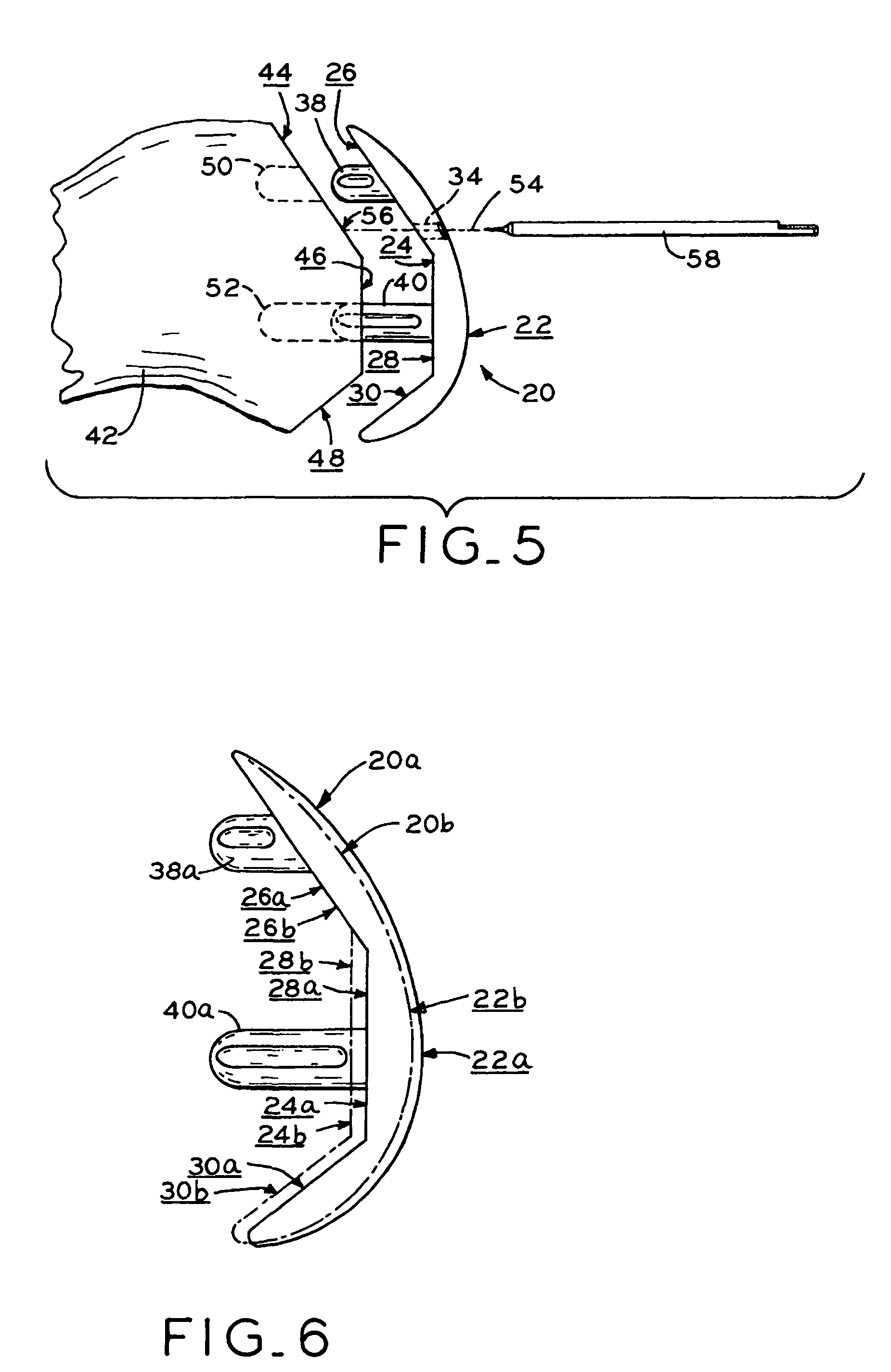 Provisional orthopedic implant and recutting instrument guide