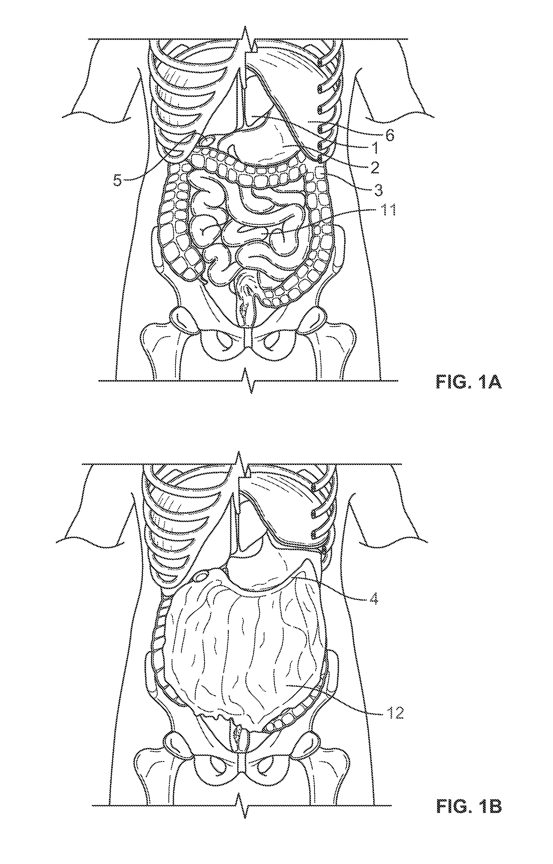 Methods and devices for removing omental tissue