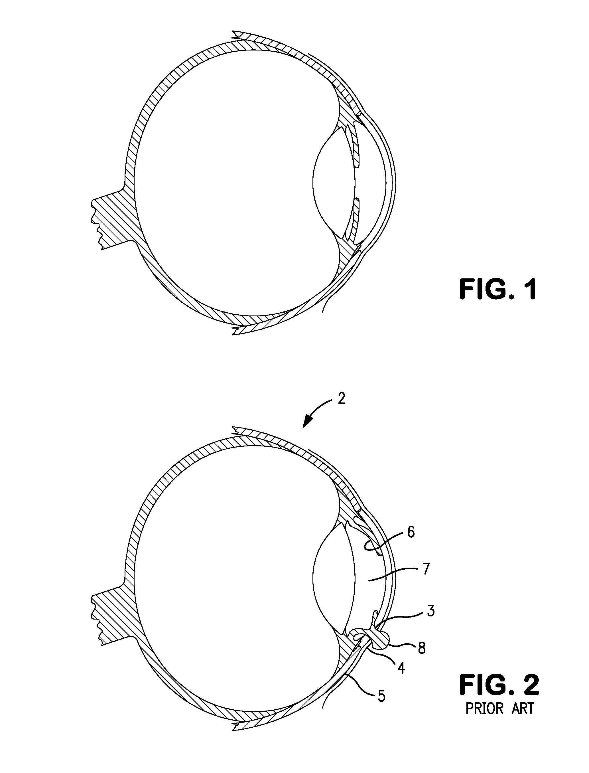 Iris shield