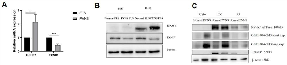 Application of GLUT1 as prevention and/or treatment target of hyperpigmented villus nodular synovitis