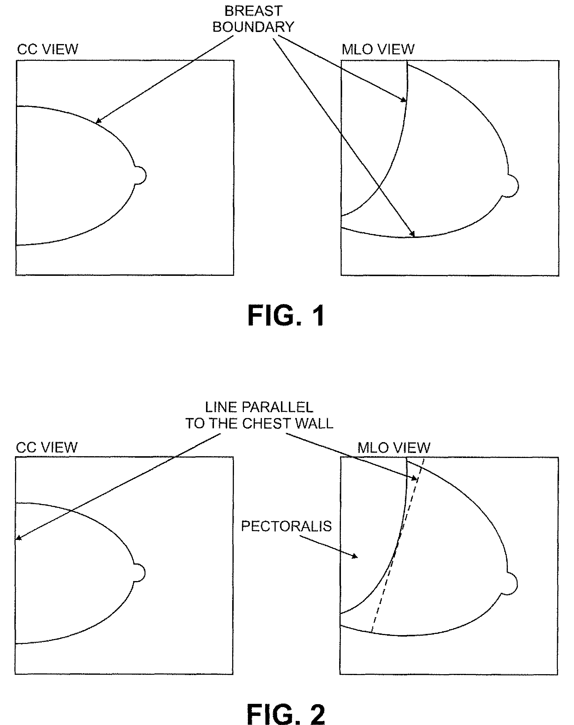 Methods and apparatus for computer automated diagnosis of mammogram images