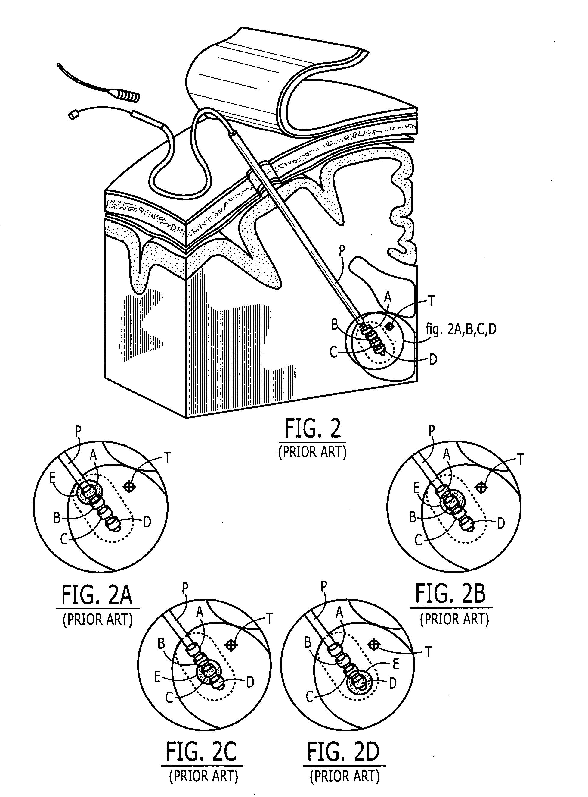Various apparatus and methods for deep brain stimulating electrodes