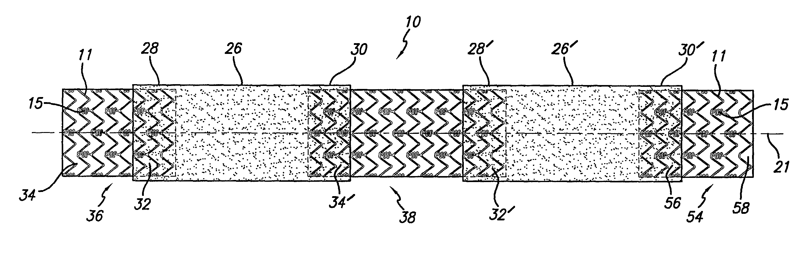 Stent assembly for the treatment of vulnerable plaque