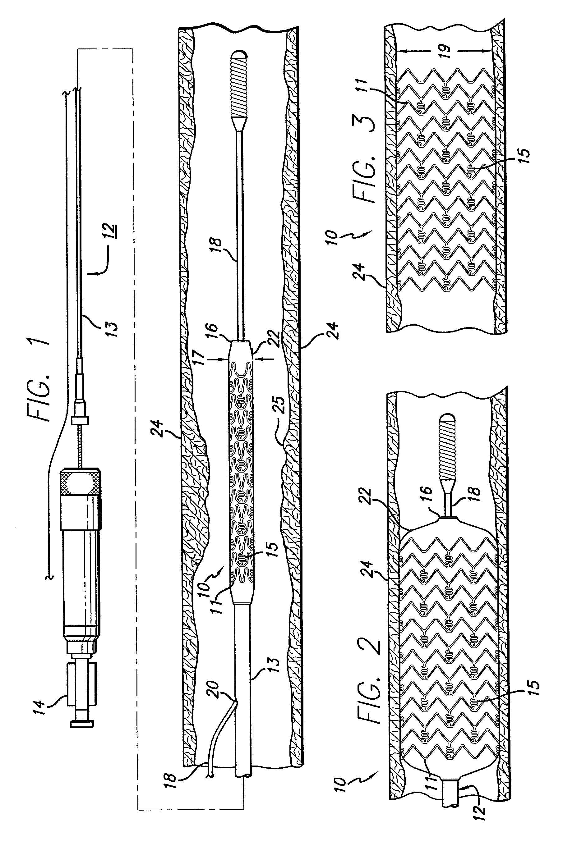 Stent assembly for the treatment of vulnerable plaque