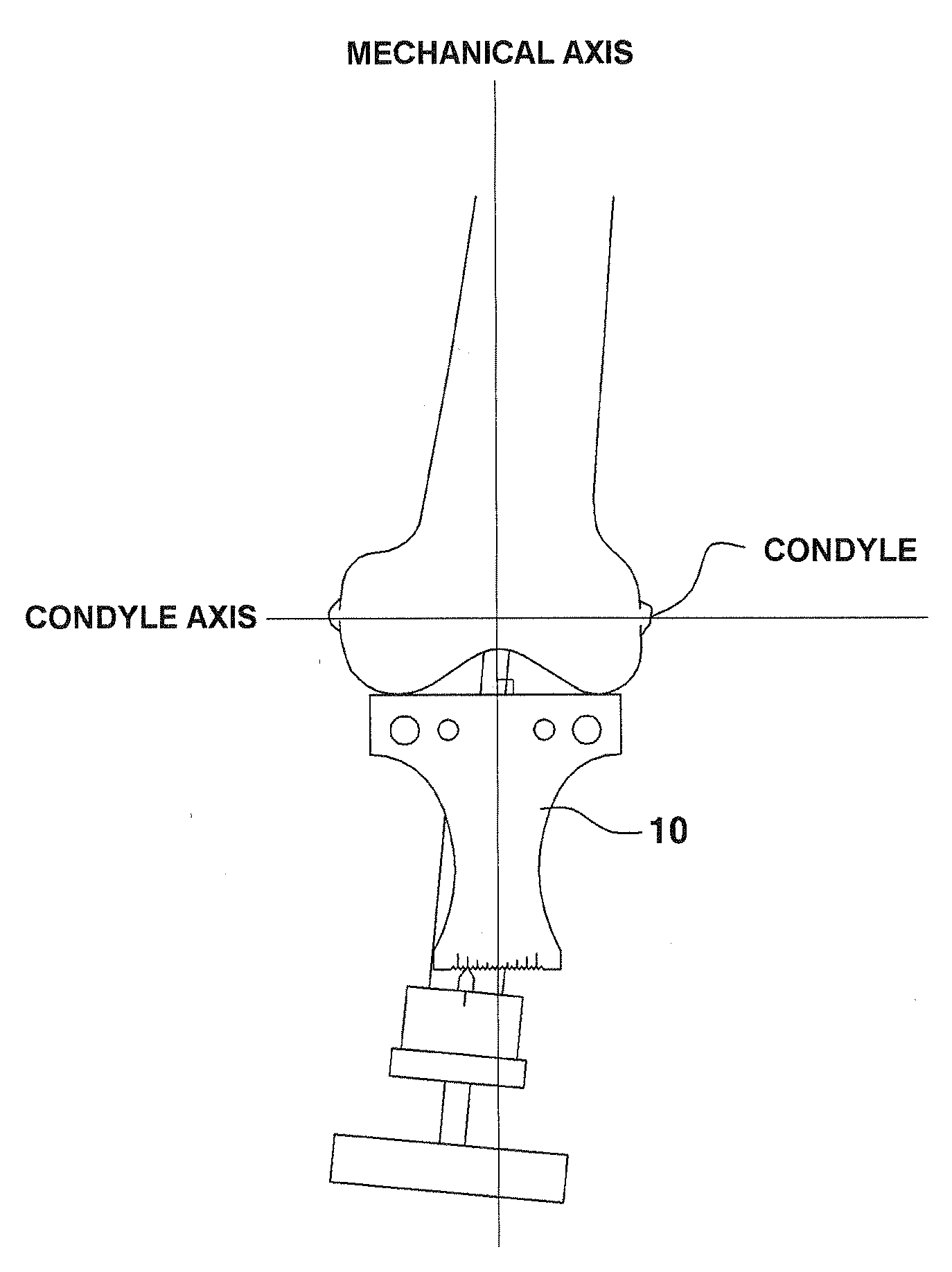 Device for Aligning and Guiding Femoral Resection Guide and Femoral Implant Impactor