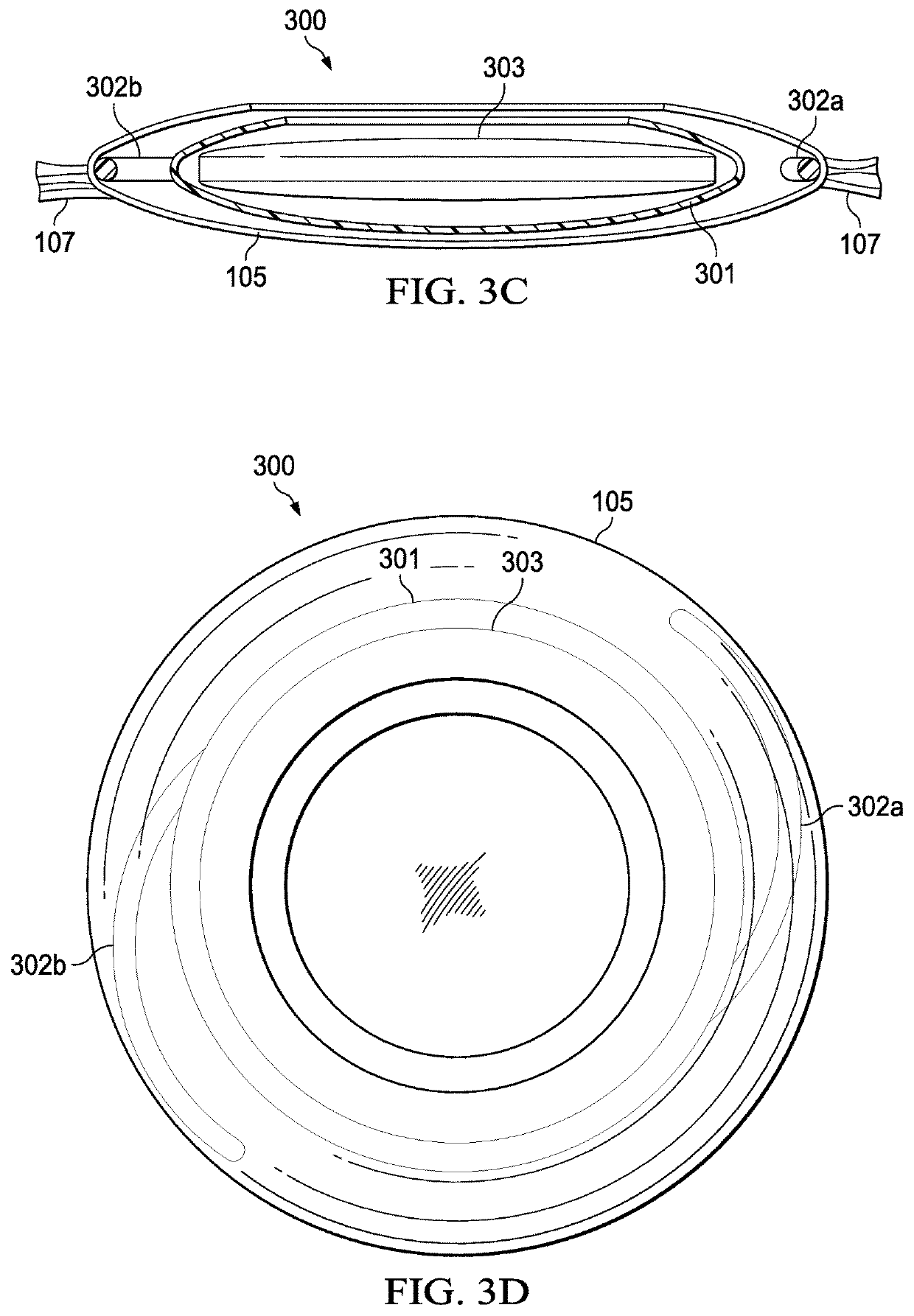 Vision correction systems and methods for using an intraocular lens enclosed in an inner capsulated bag