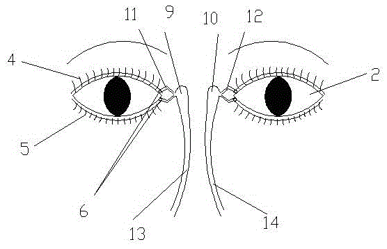 A nursing teaching model of cutting eyelashes and lacrimal duct flushing technology in ophthalmology department