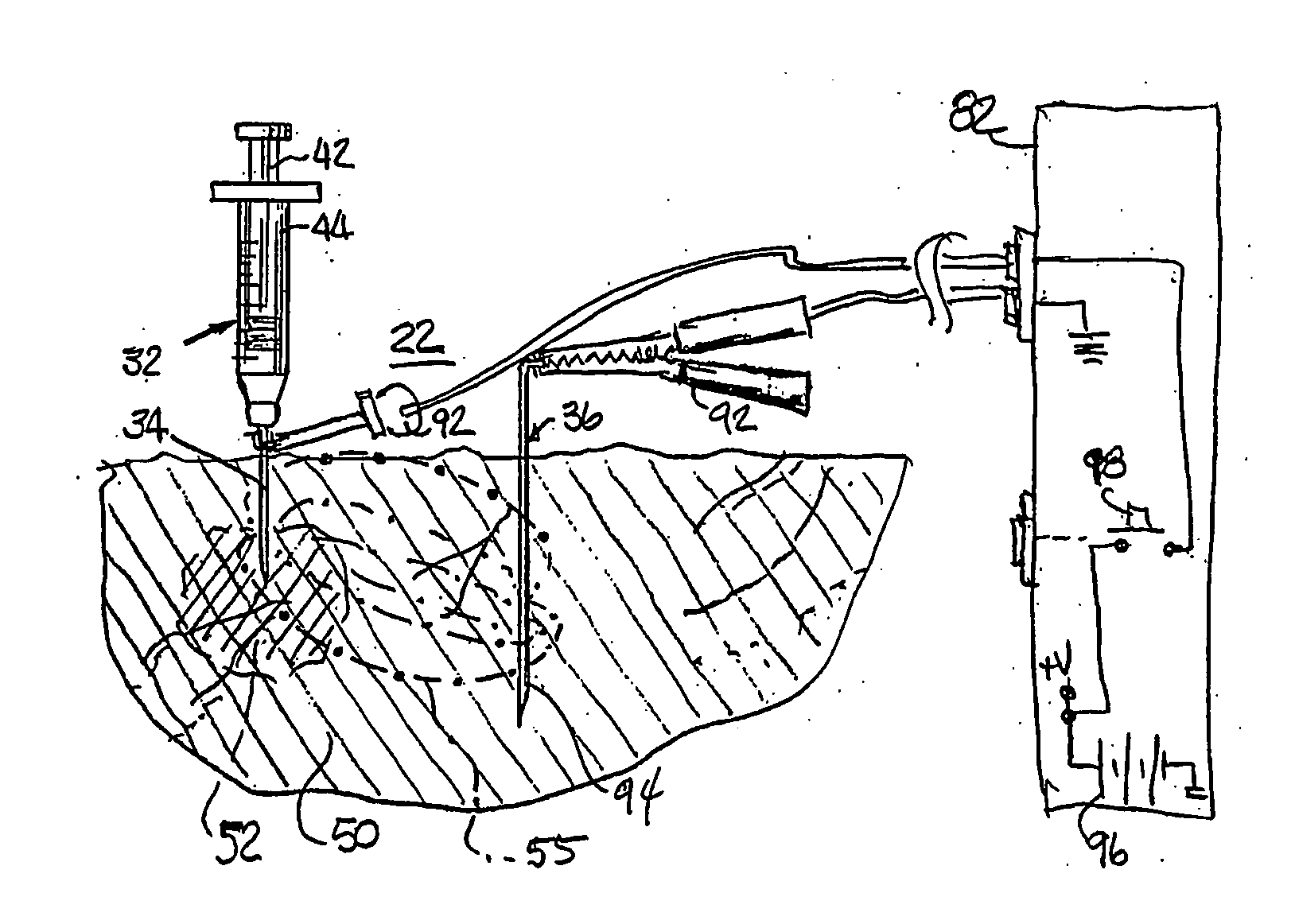 Clinical syringe with electrical stimulation aspects