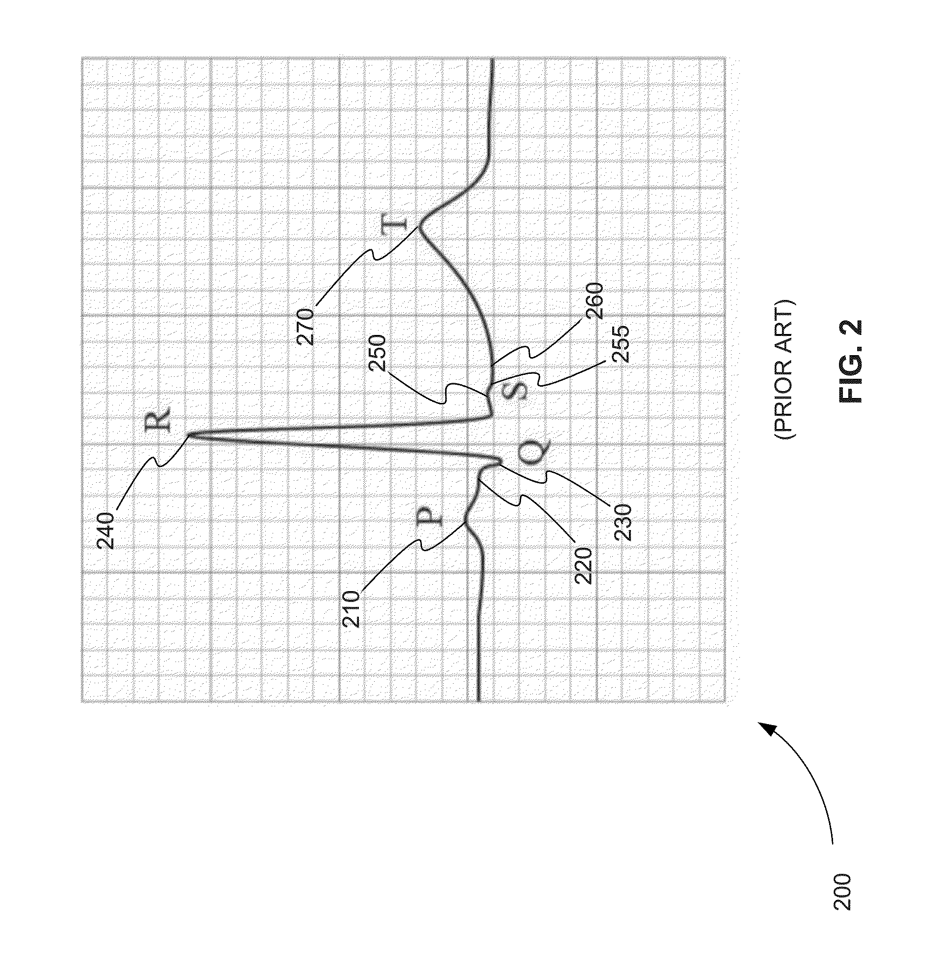 Systems and Methods for Detecting ECG Subwaveforms