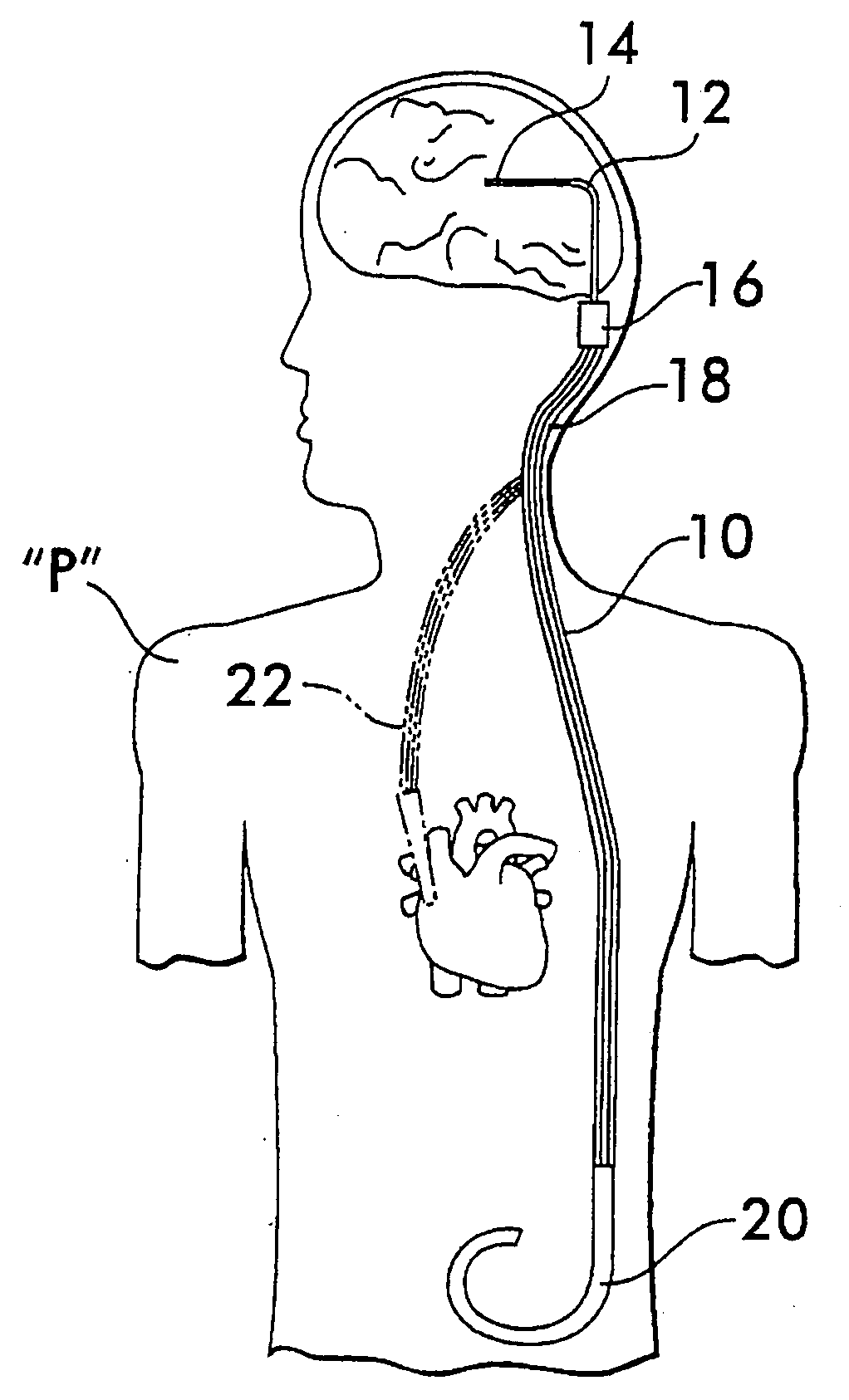 Implantable shunt or catheter enabling gradual delivery of therapeutic agents