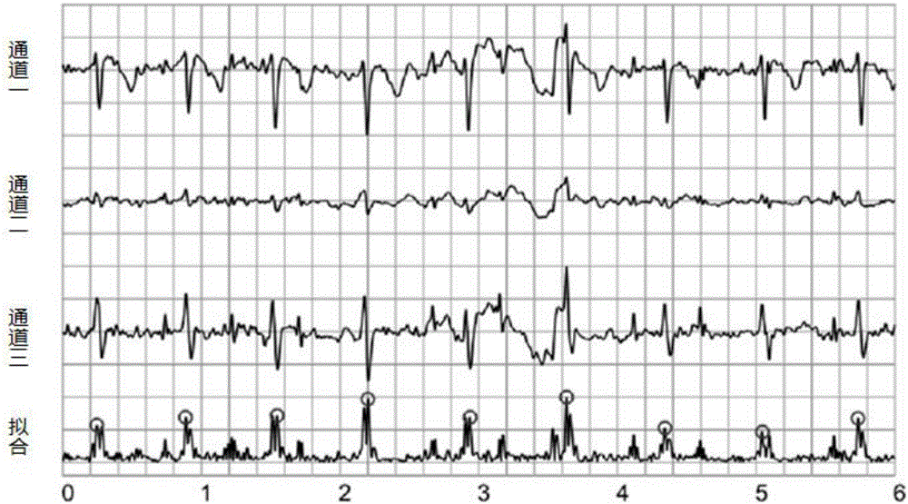 A method of automatic delineation of qrs for multi-channel electrocardiogram