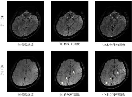 A post-processing method and system for magnetic resonance susceptibility weighted imaging