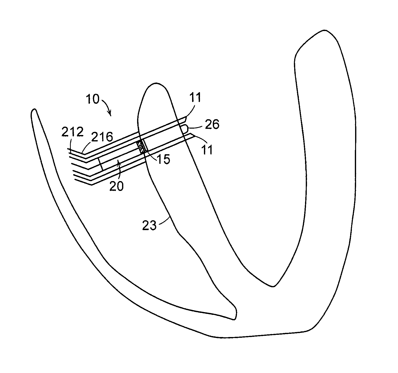 Devices and methods for tissue transplant and regeneration