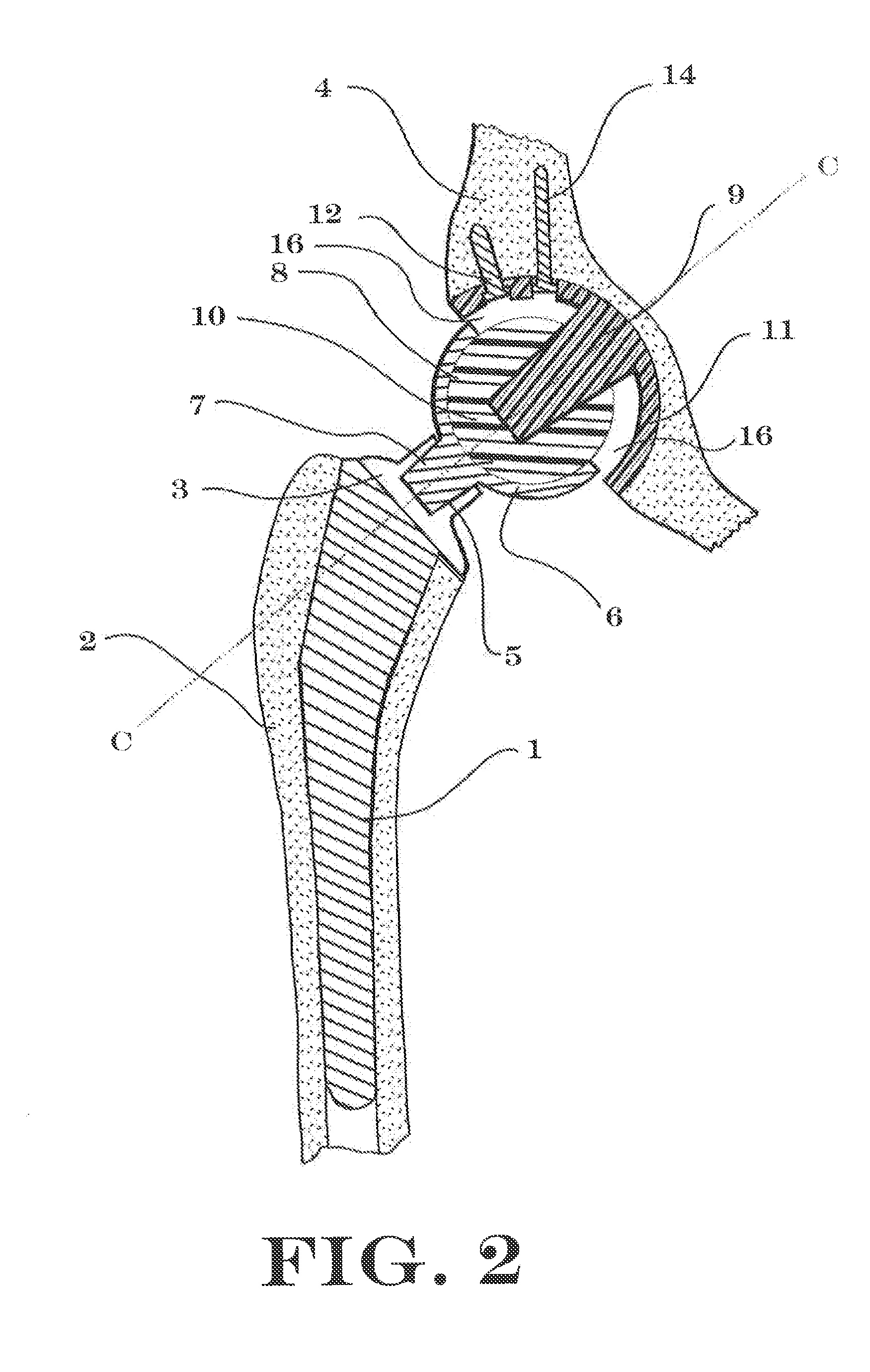 Interlocking Reverse Hip and Revision Prosthesis