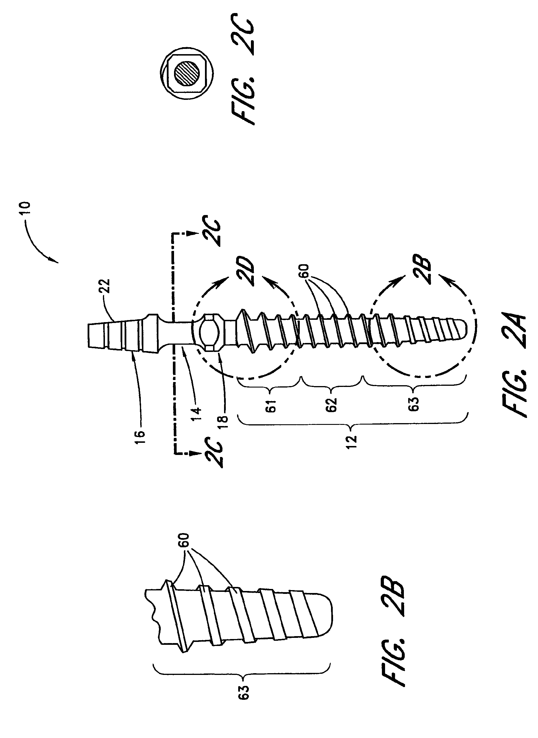 Immediate provisional implant