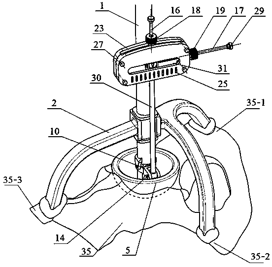 Acetabular prosthesis positioning device and method for unilateral hip joint revision surgery