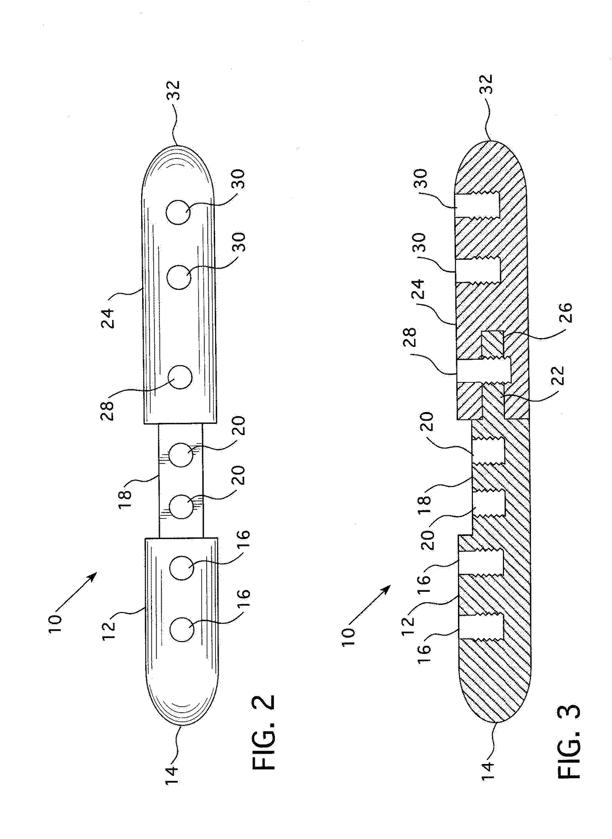 Intramedullary Nail