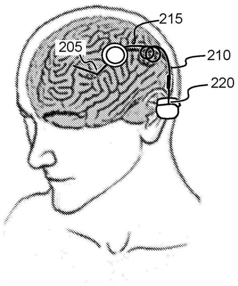 Stimulation system with monolithic-lead component connected to skull mount package