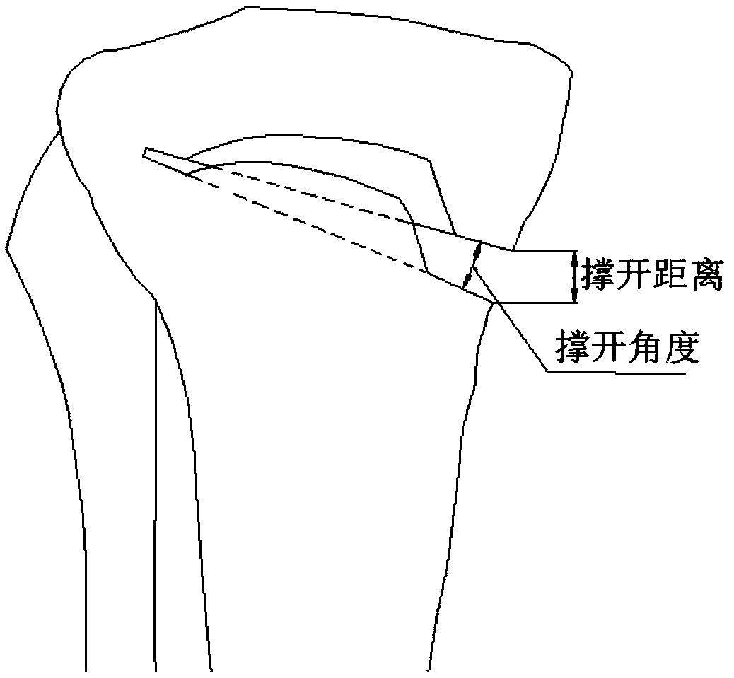 Open-type wedge osteotomy device