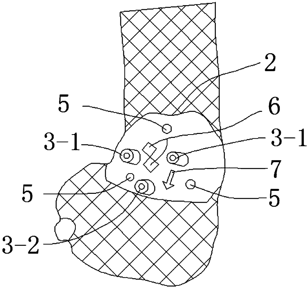 Open-type wedge osteotomy device