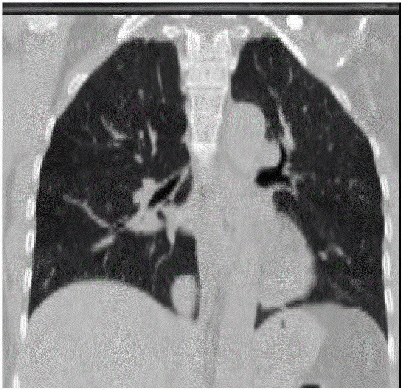 Four-dimensional-computed tomography (4D-CT) image data interlayer interpolation method for lung