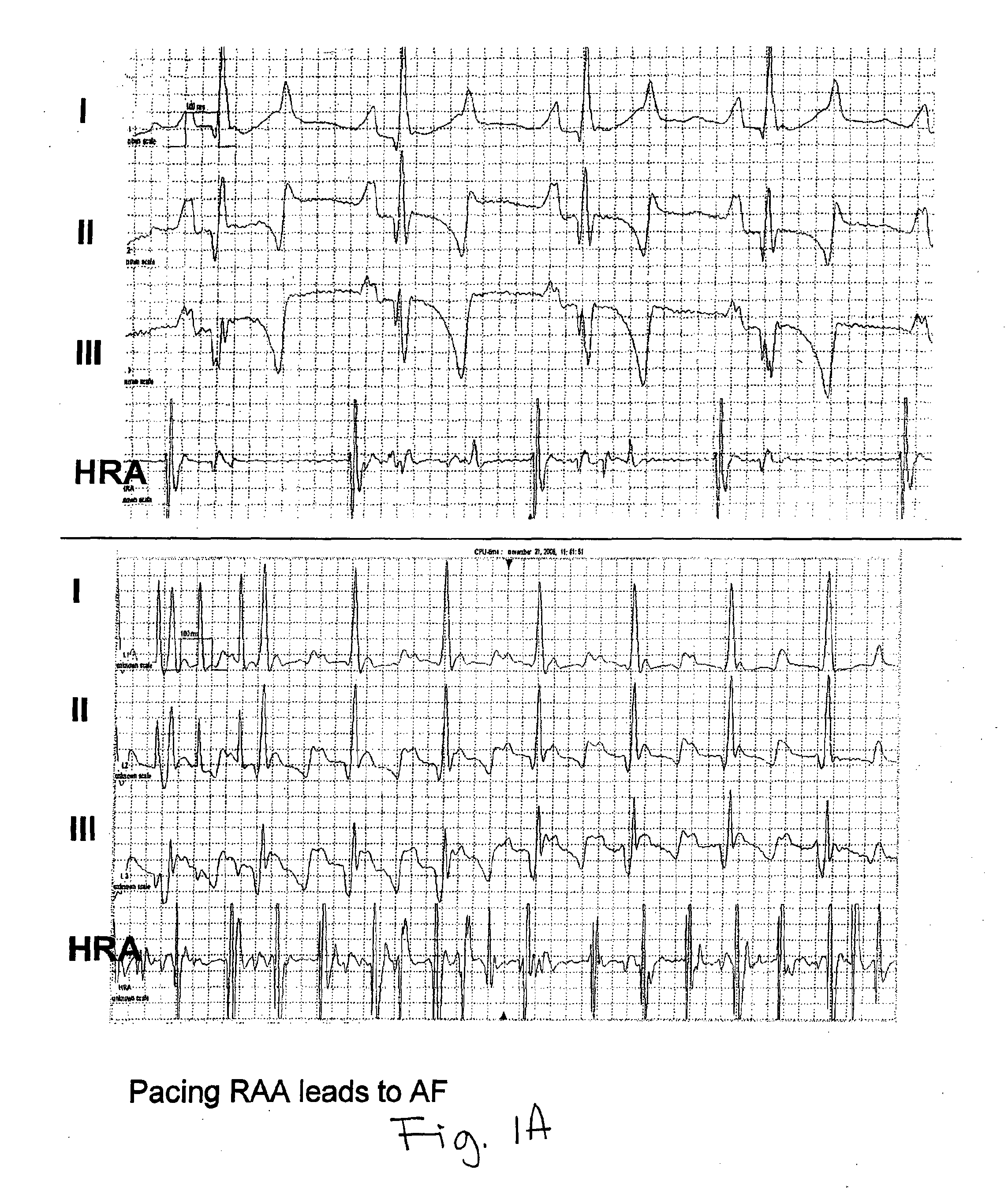 Methods and compositions to treat arrhythmias