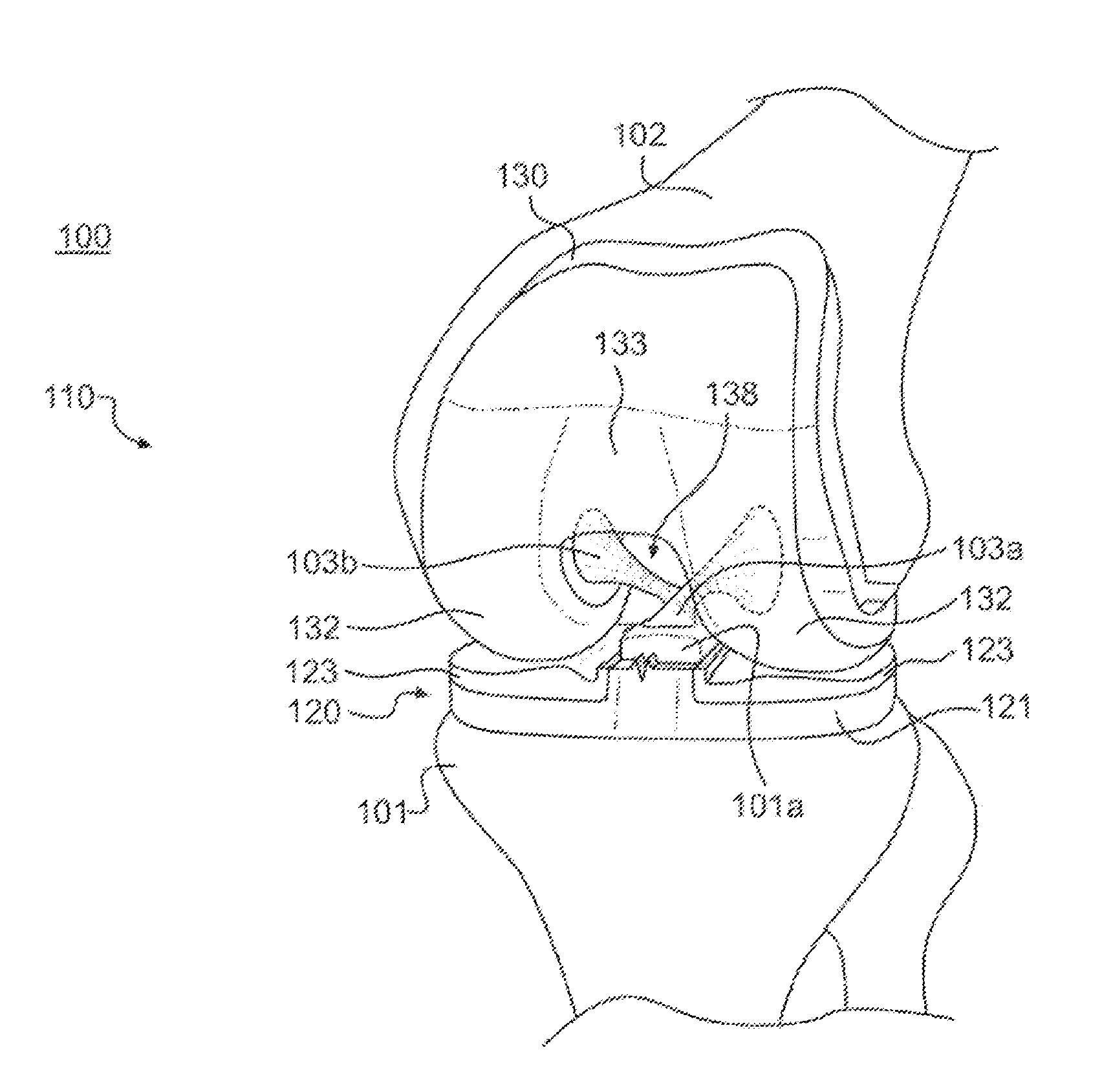 Cruciate-retaining tibial prosthesis