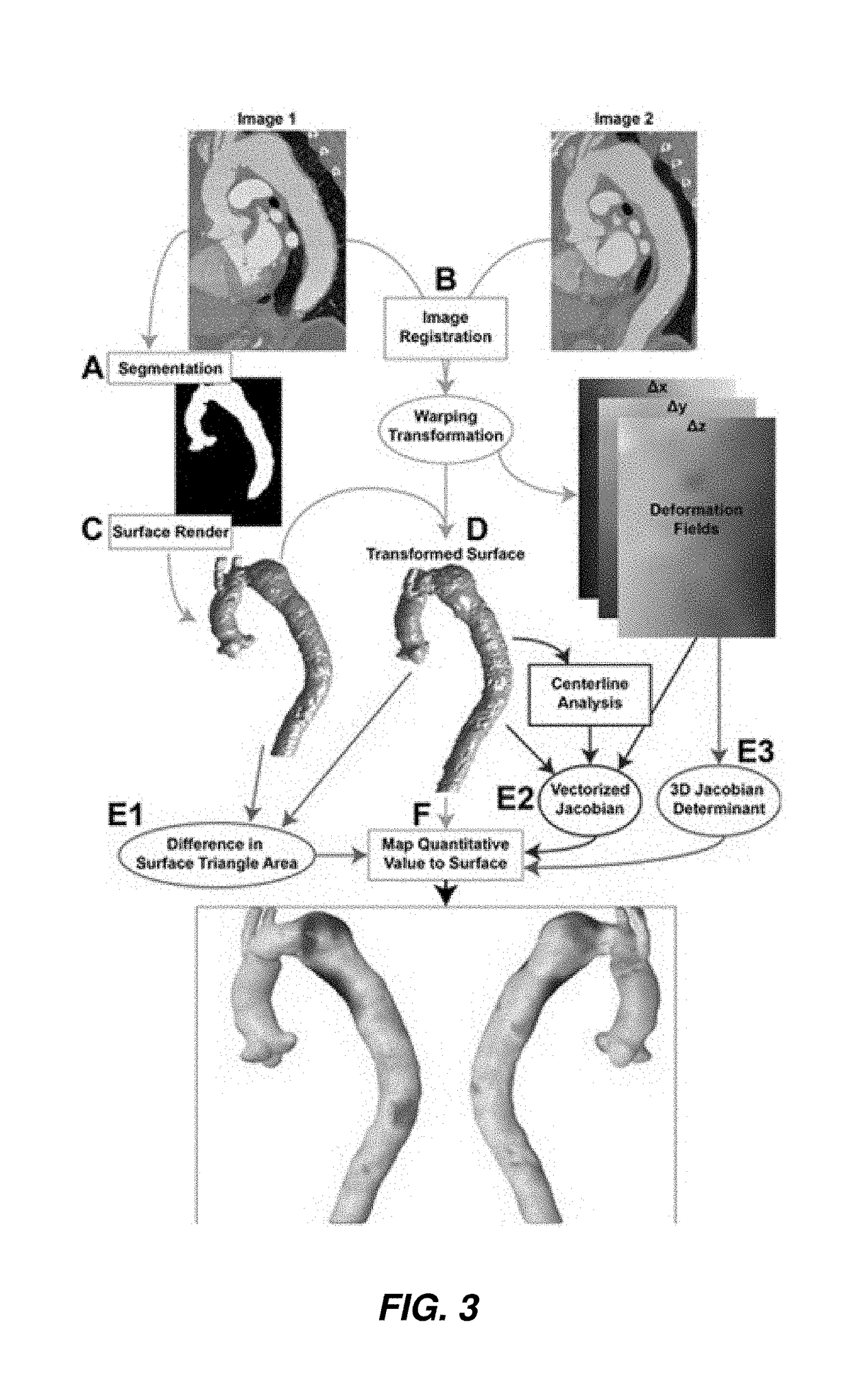 Techniques of deformation analysis for quantification of vascular enlargement